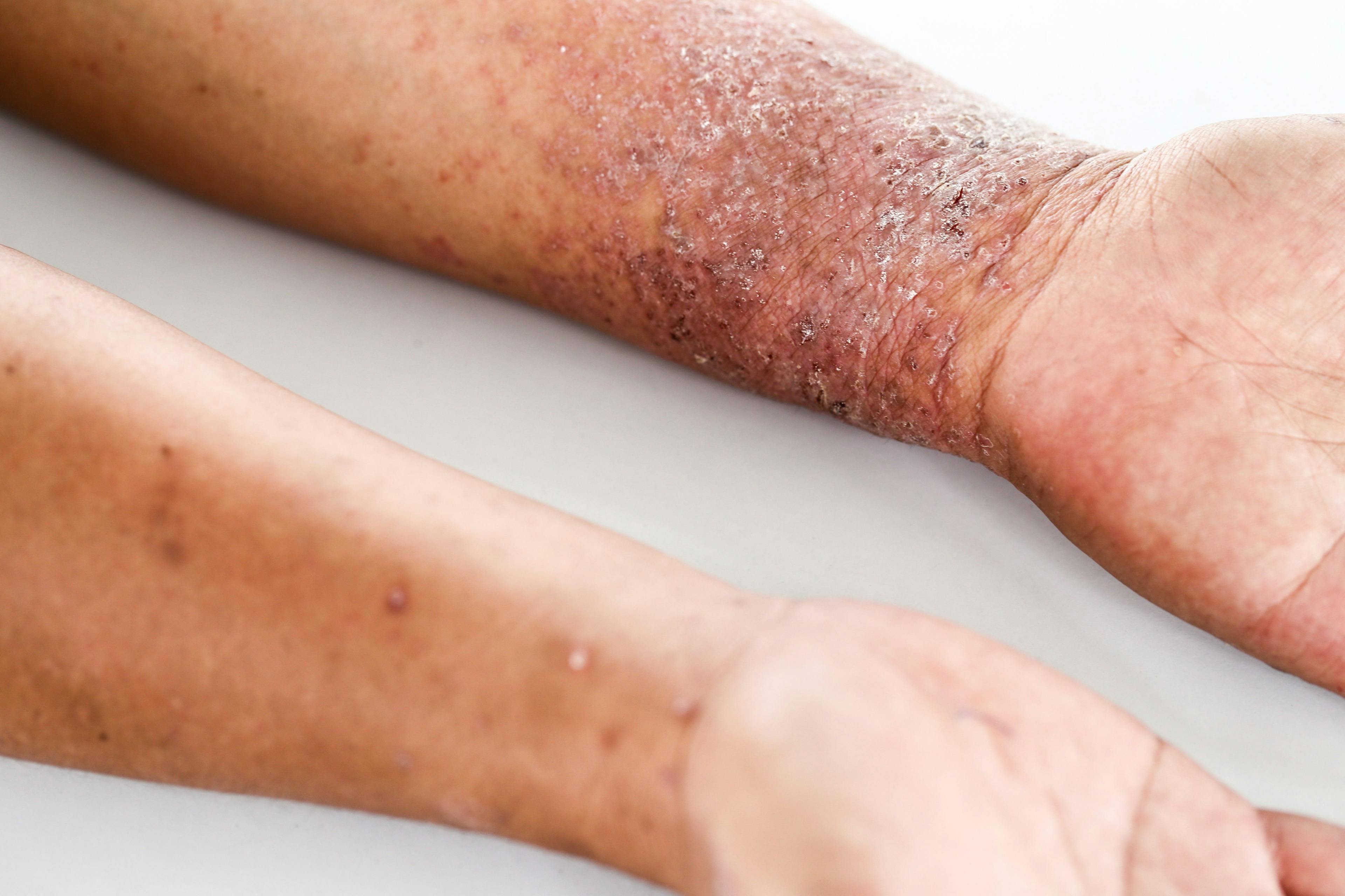 Phase 3 results show abrocitinib safe, effective for atopic dermatitis