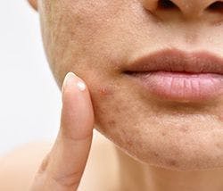 Next-Generation Therapies and Approaches Will Advance Acne Treatment
