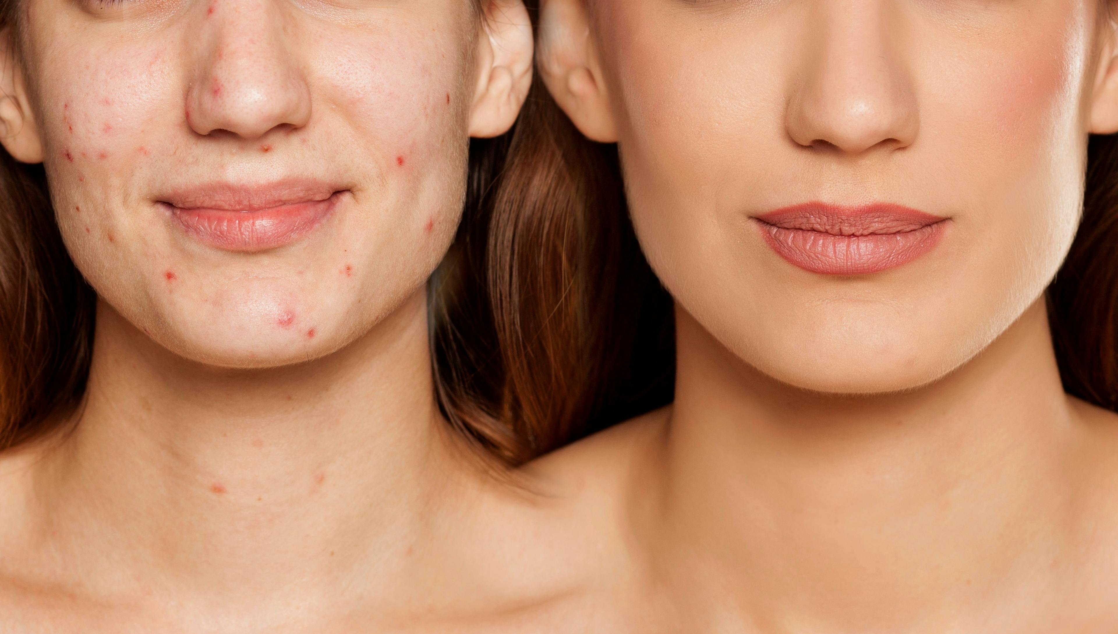 Finding the Right Acne Regimen for Your Patients