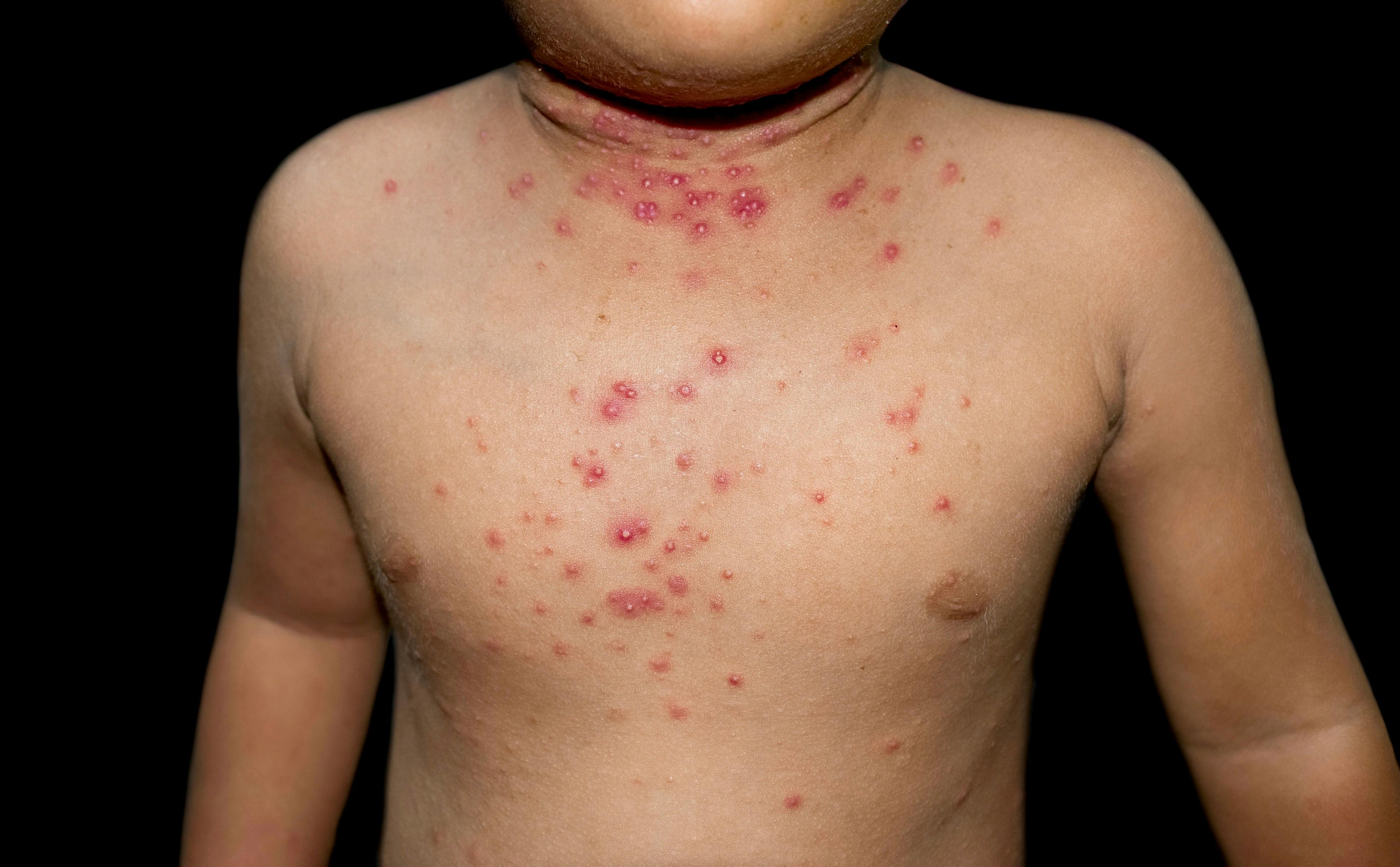 Molluscum contagiosum skin lesions on a child (ZayNyi/Adobe Stock)