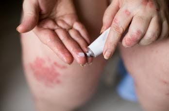 MC2 Therapeutics collaborates EPI Health on newly approved psoriasis topical