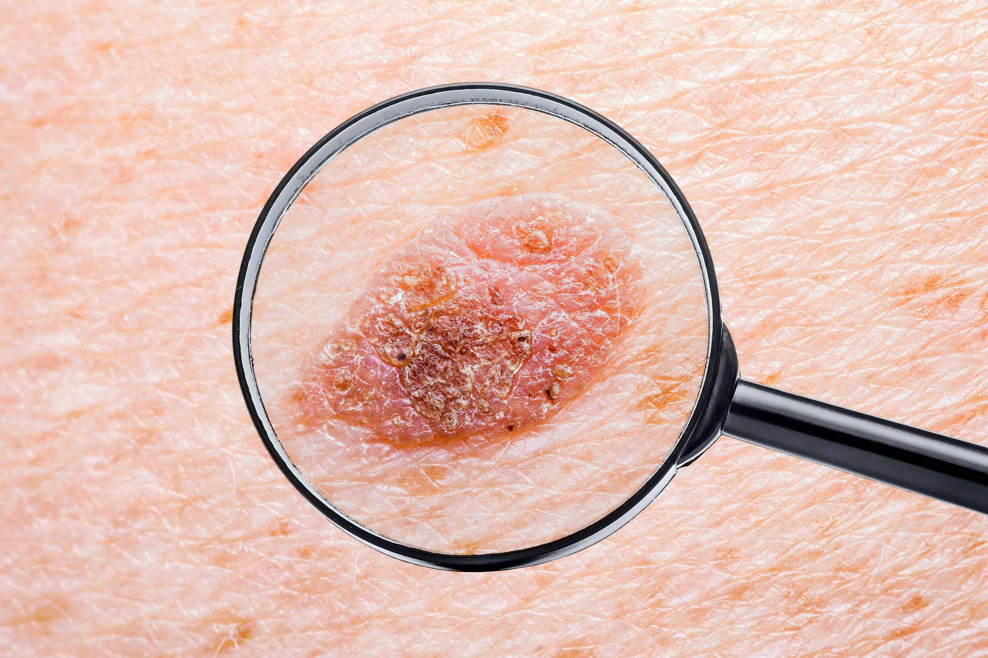 Study: Skin Cancer Detection Apps Fail to Correctly Classify Life-Threatening Cancers