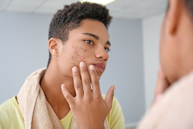Promoting Beneficial Skin Care and Self Care Habits Among Teenagers  