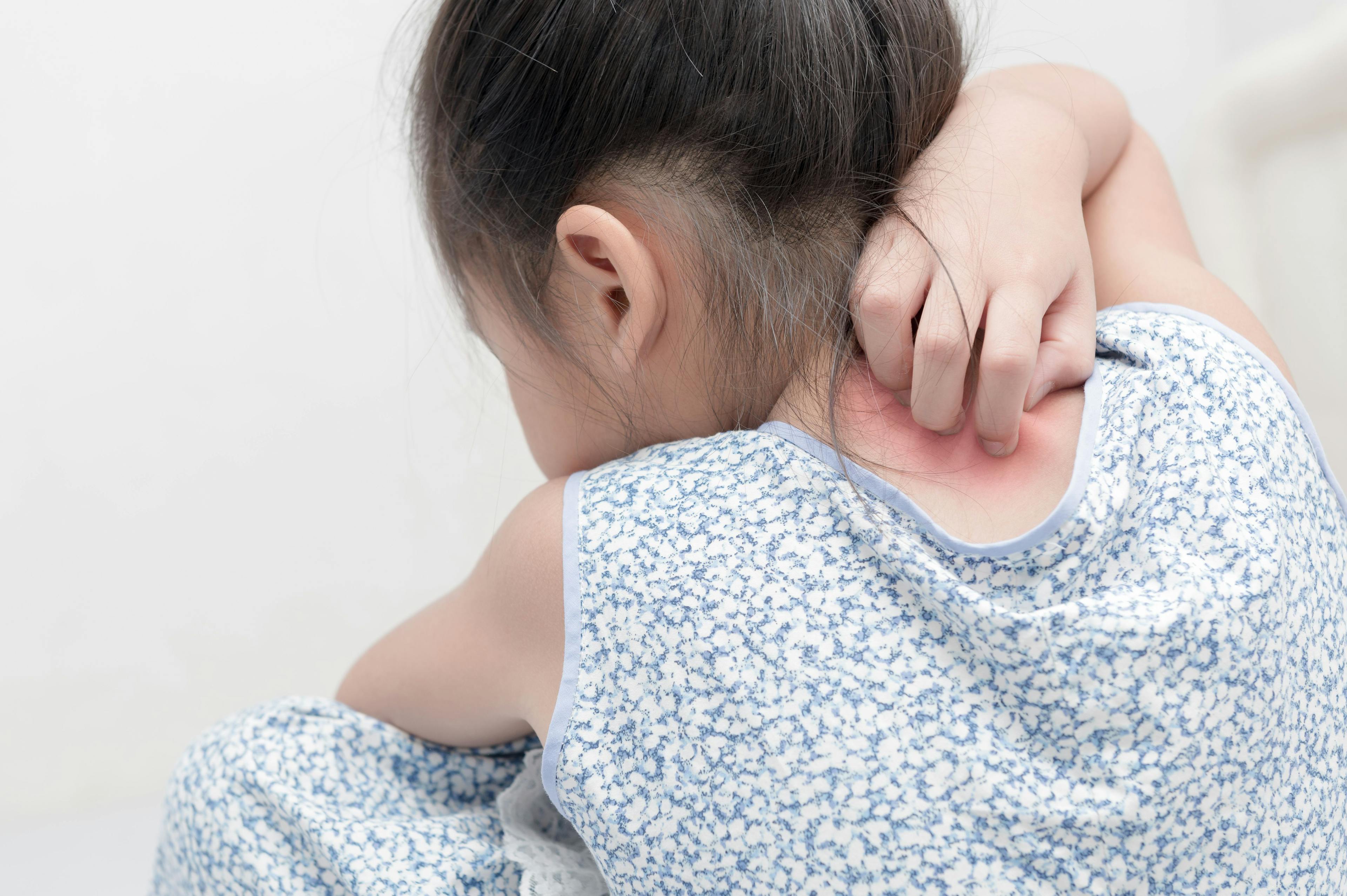 An Overview of Pediatric Psoriasis