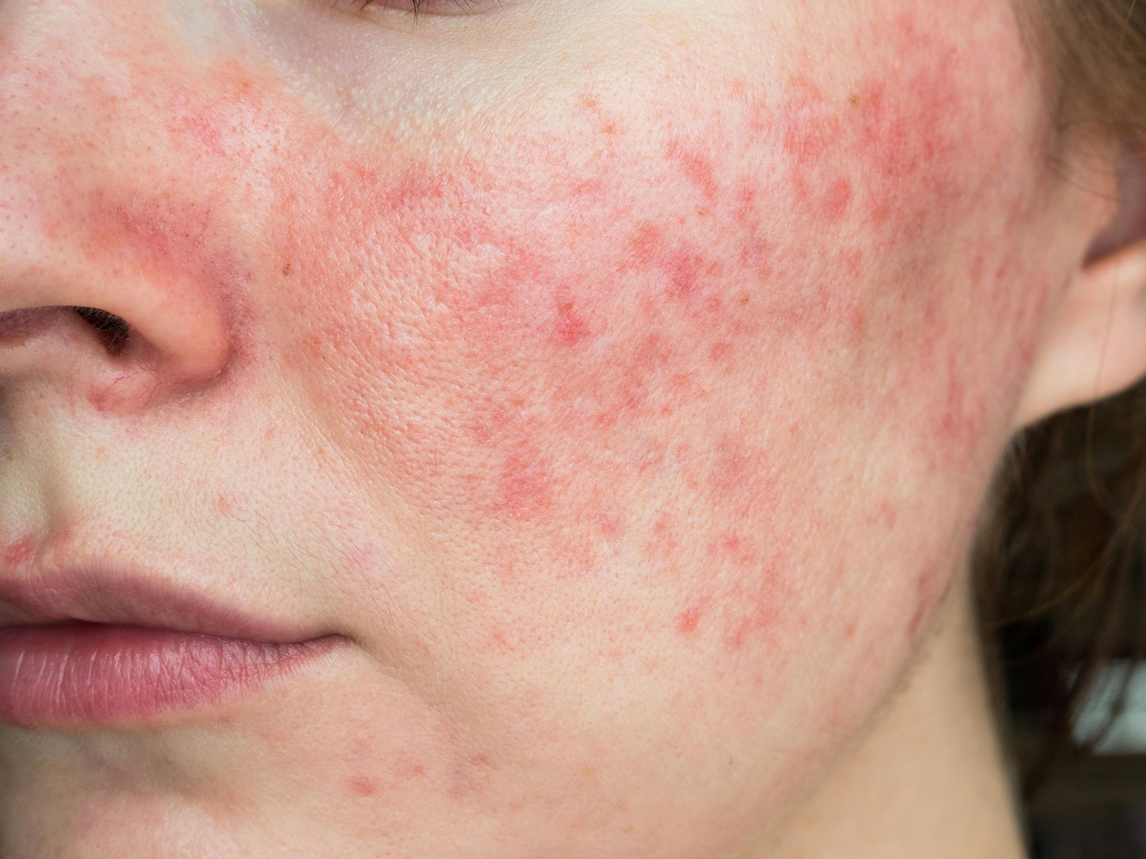 Low Levels of Serum GLA in Rosacea Negatively Associated With Erythema, Anxiety, and Depression