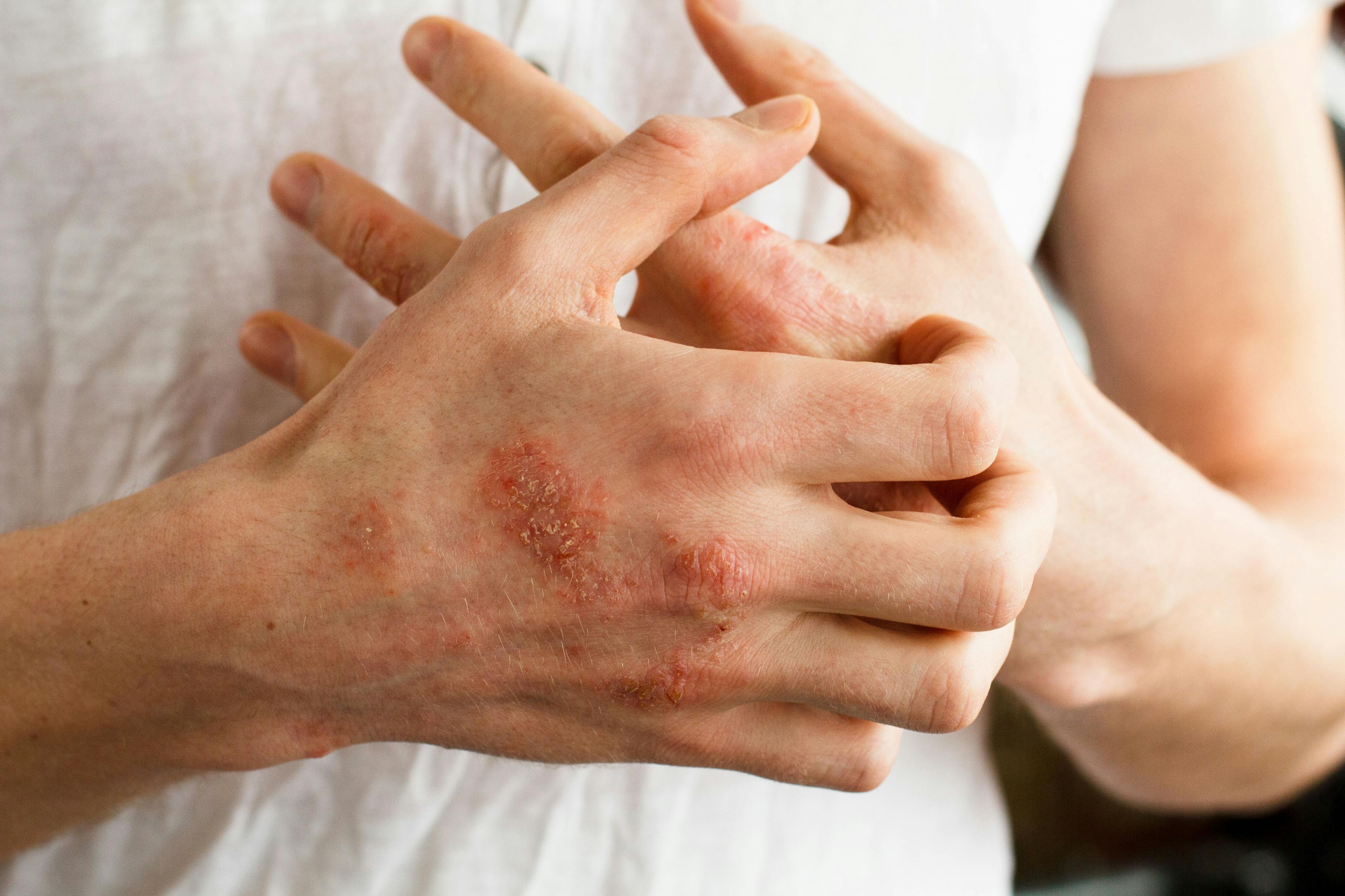 Exposure to Heavy Traffic Affects Risk of Atopic Dermatitis