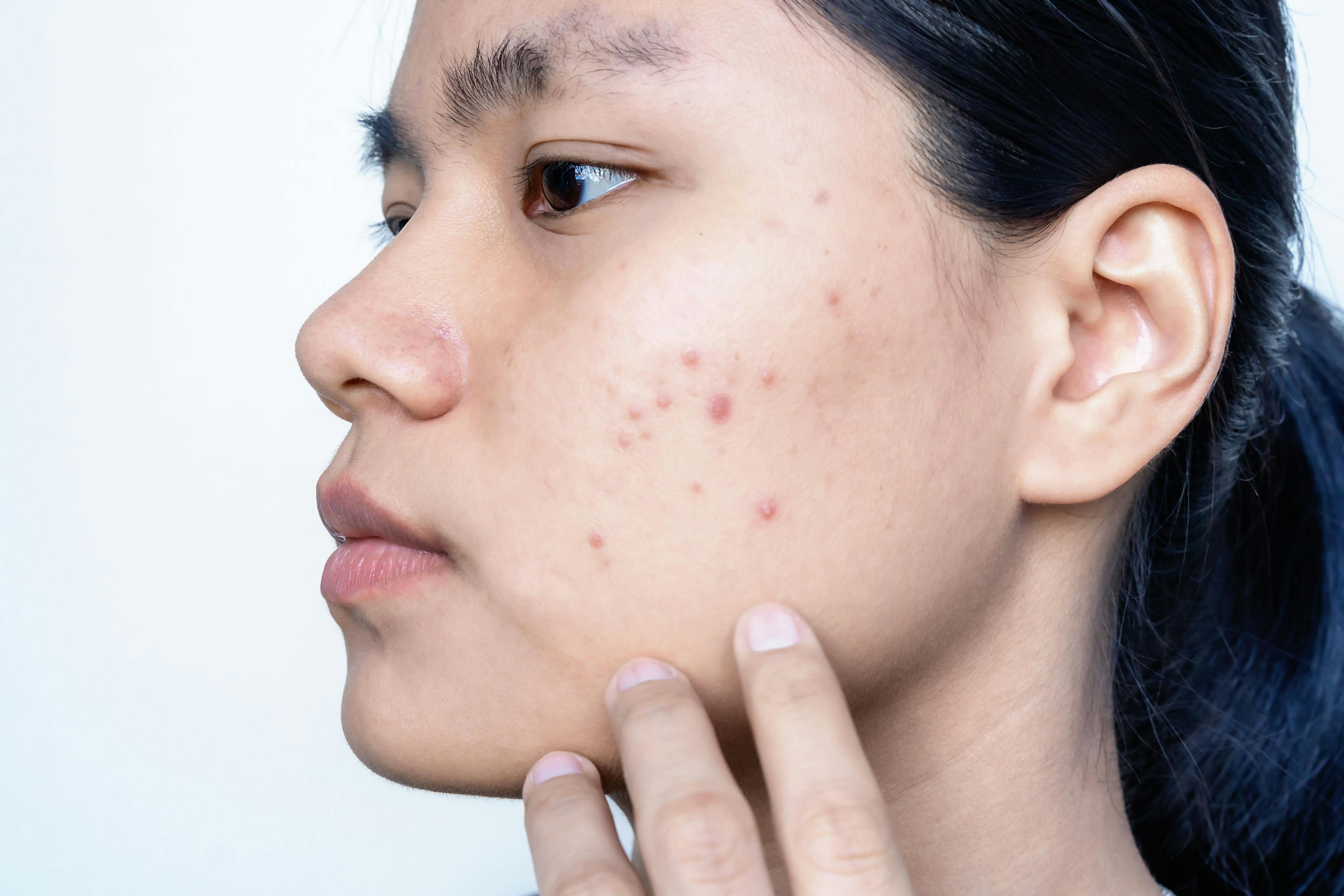Study: Family History May Factor in Acne Presentation, Severity, and Scarring
