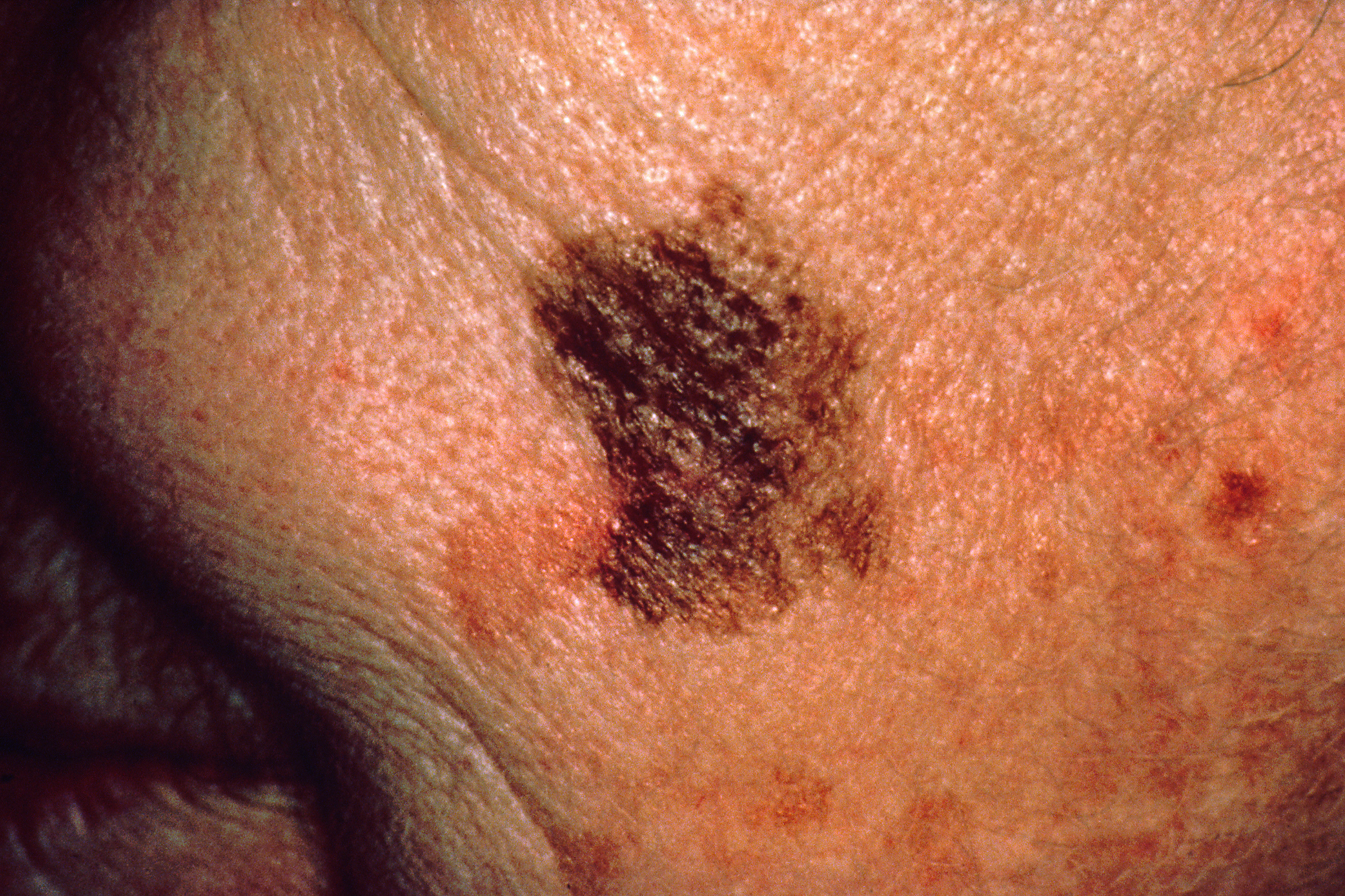 Oncology Pharmacists Are Crucial in Skin Cancer Management