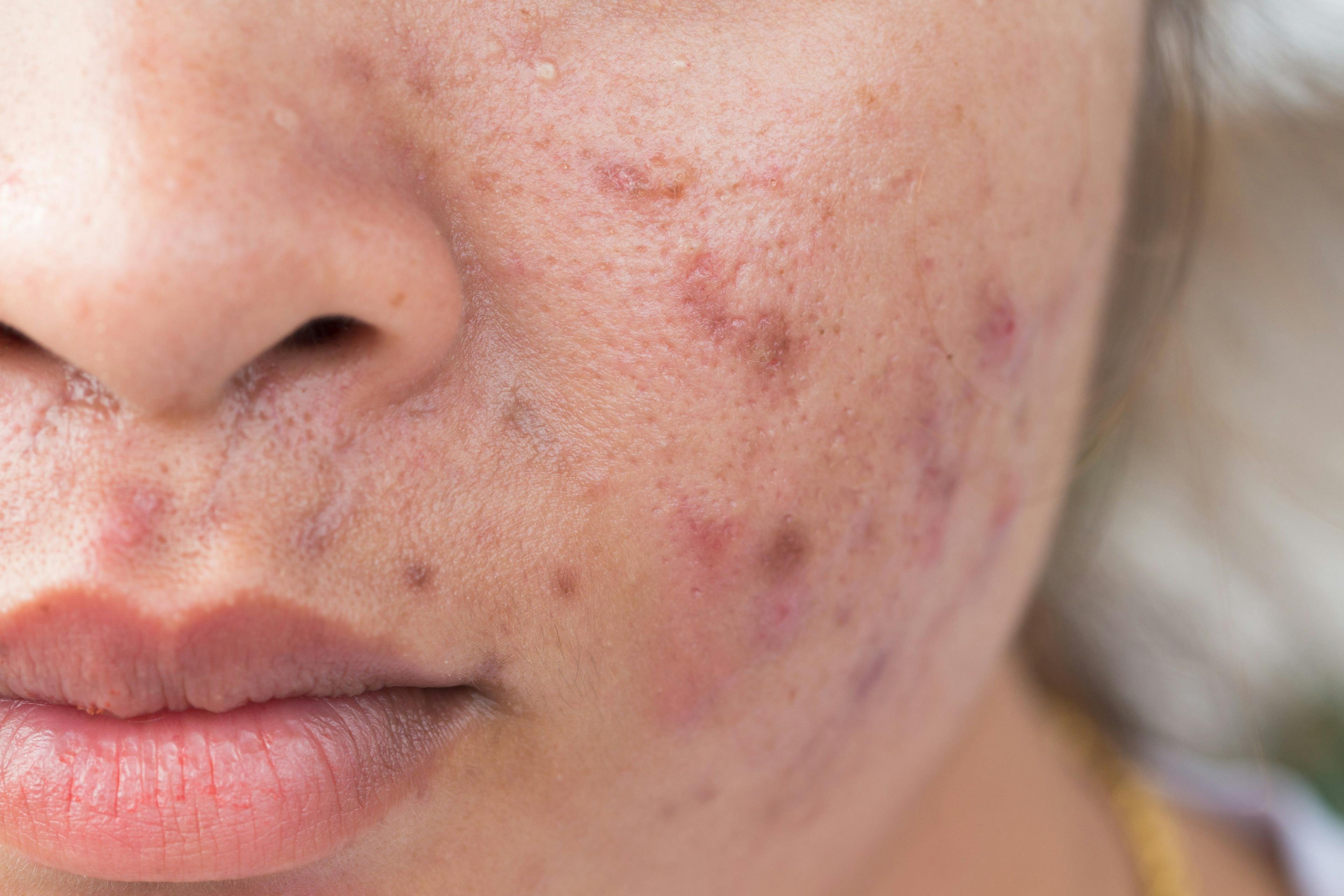 acne lesions on face
