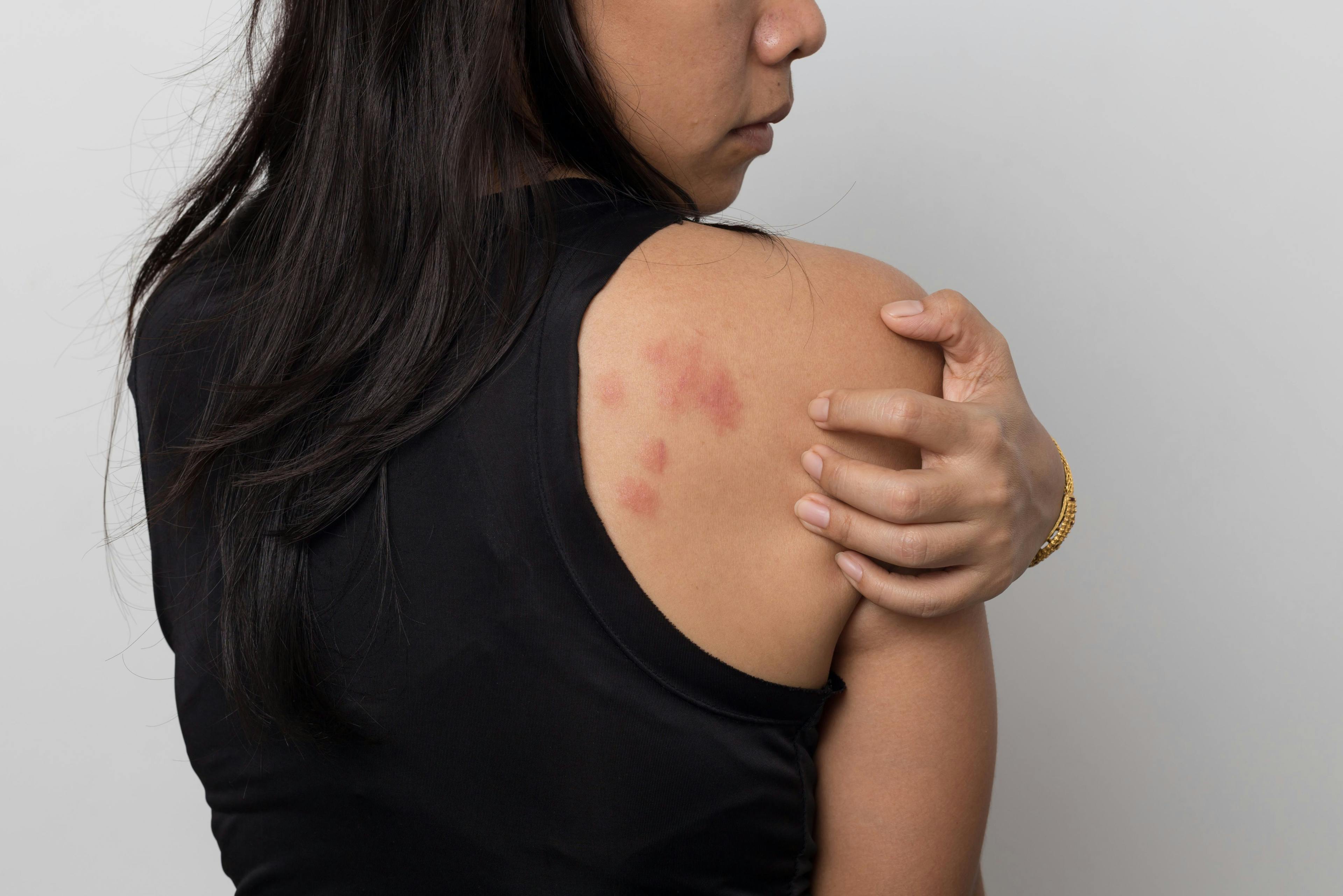 Woman with urticaria on the back of her shoulder.