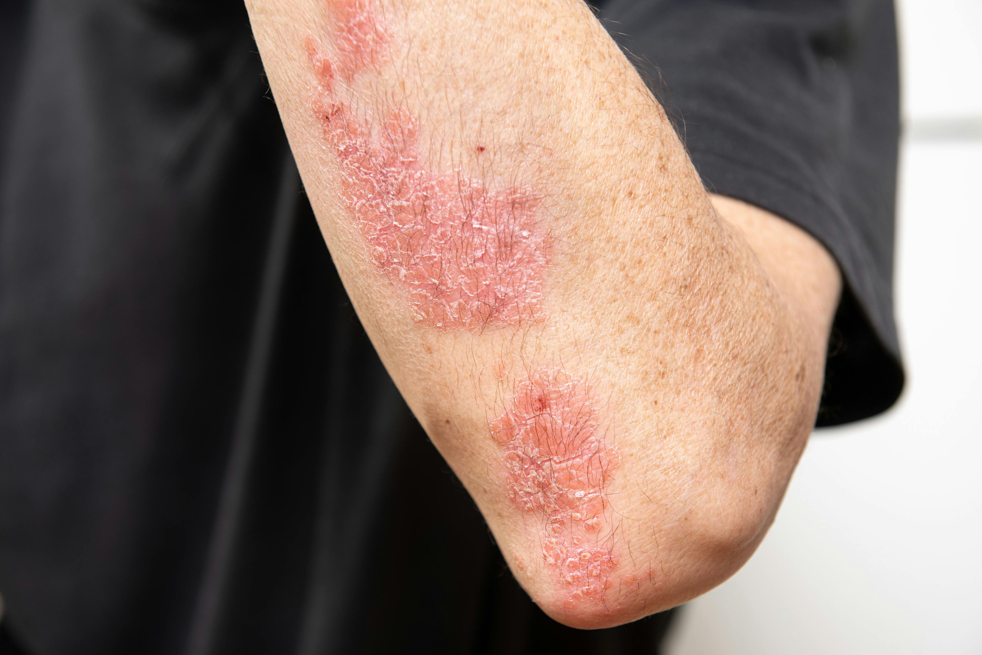High Levels of Cholesterol, Low-Density Lipoprotein Cholesterol, Among Genetic Risk Factors for Psoriasis