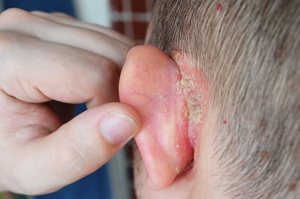 psoriasis behind ear