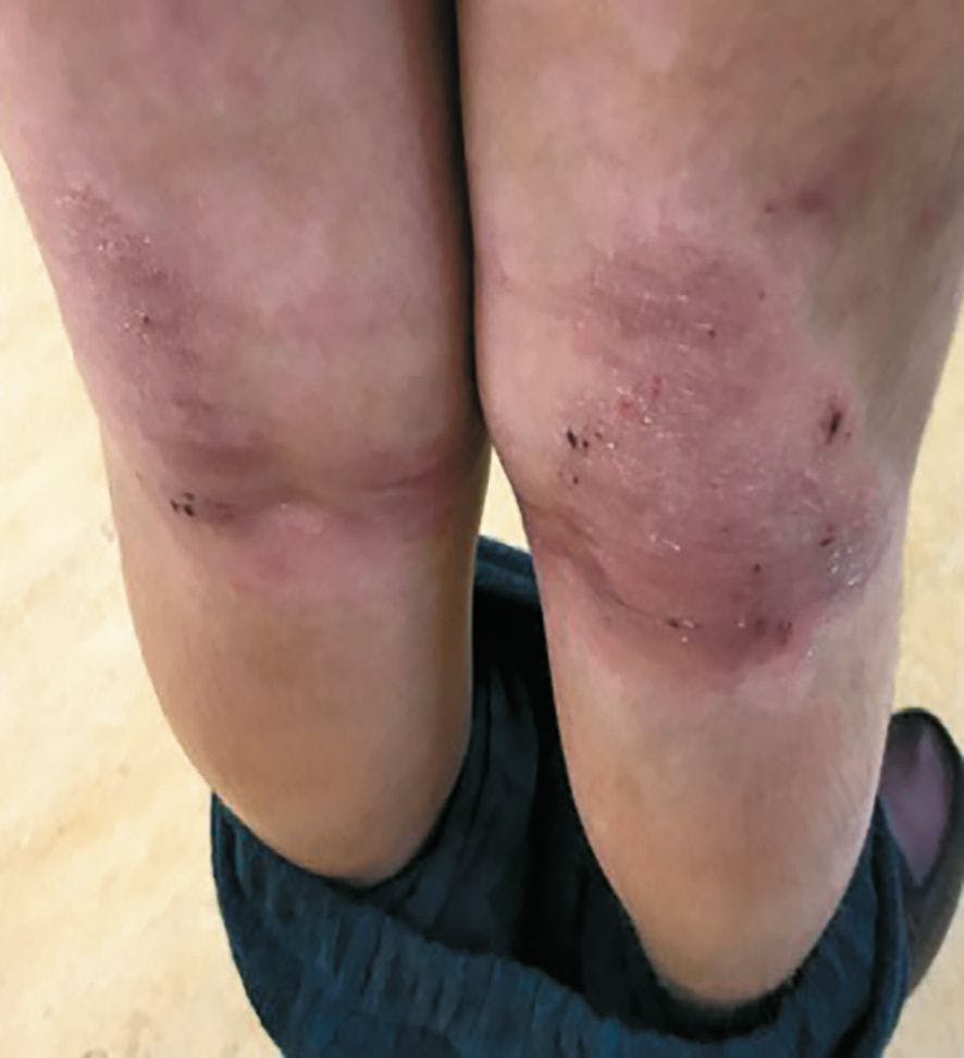 Adolescent patients ~age 13 with atopic  dermatitis, shown at baseline. (Photos courtesy Emma Guttman-Yassky, M.D., Ph.D.)