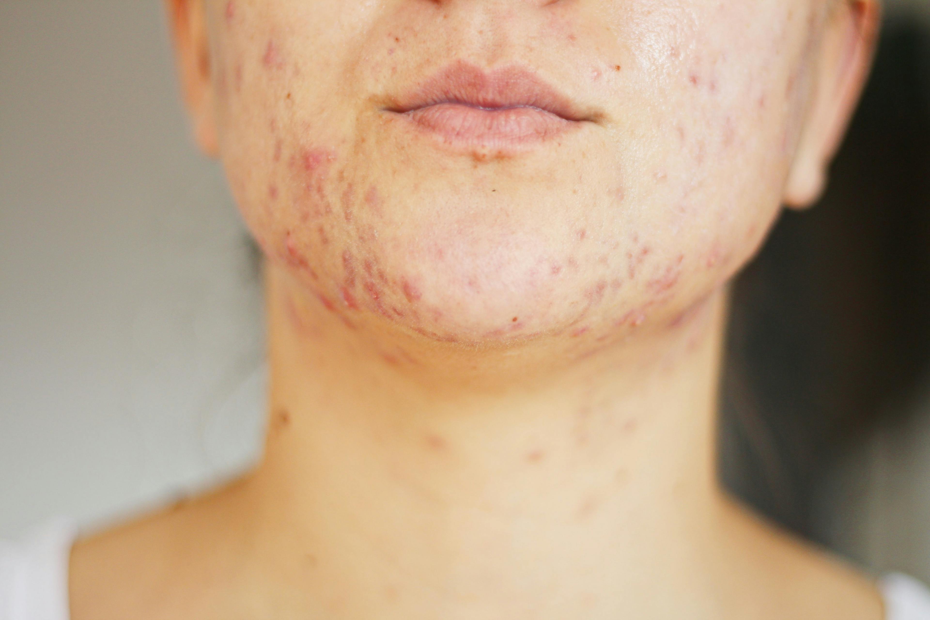 Compound Glycyrrhizin Injections More Efficacious in Acne Than Clindamycin