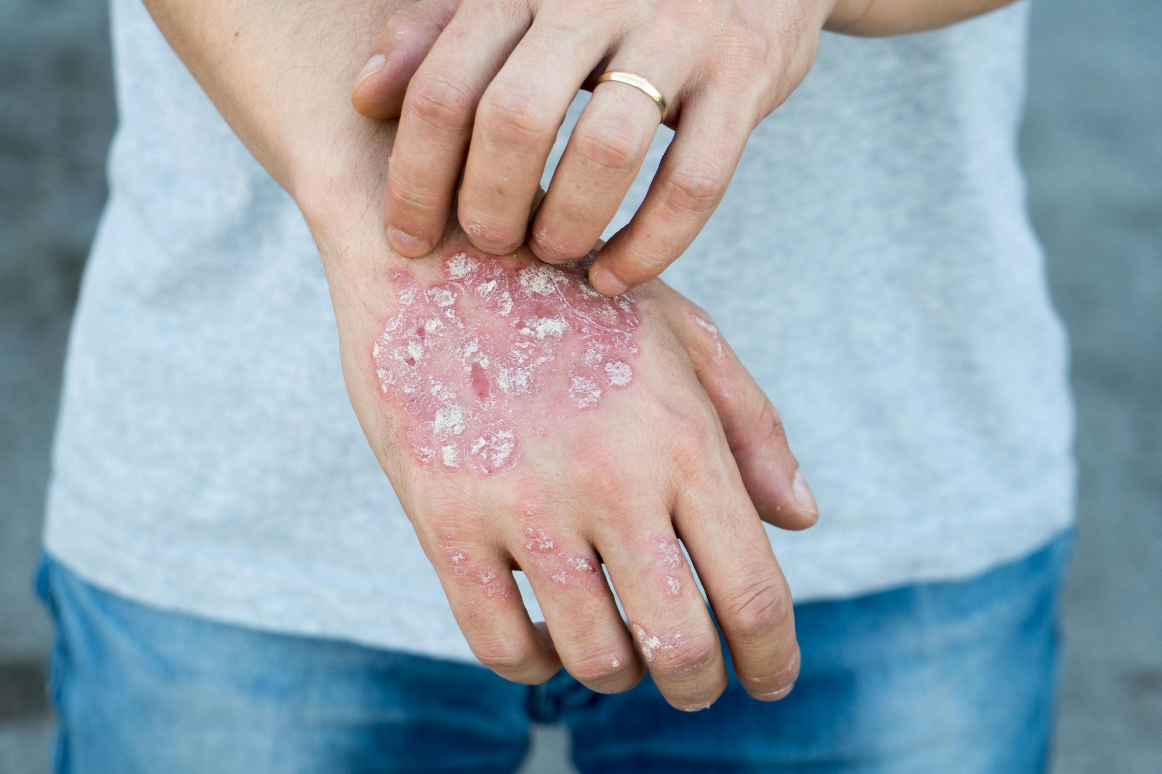 Phase 2 EDP1815 Data for Psoriasis Released