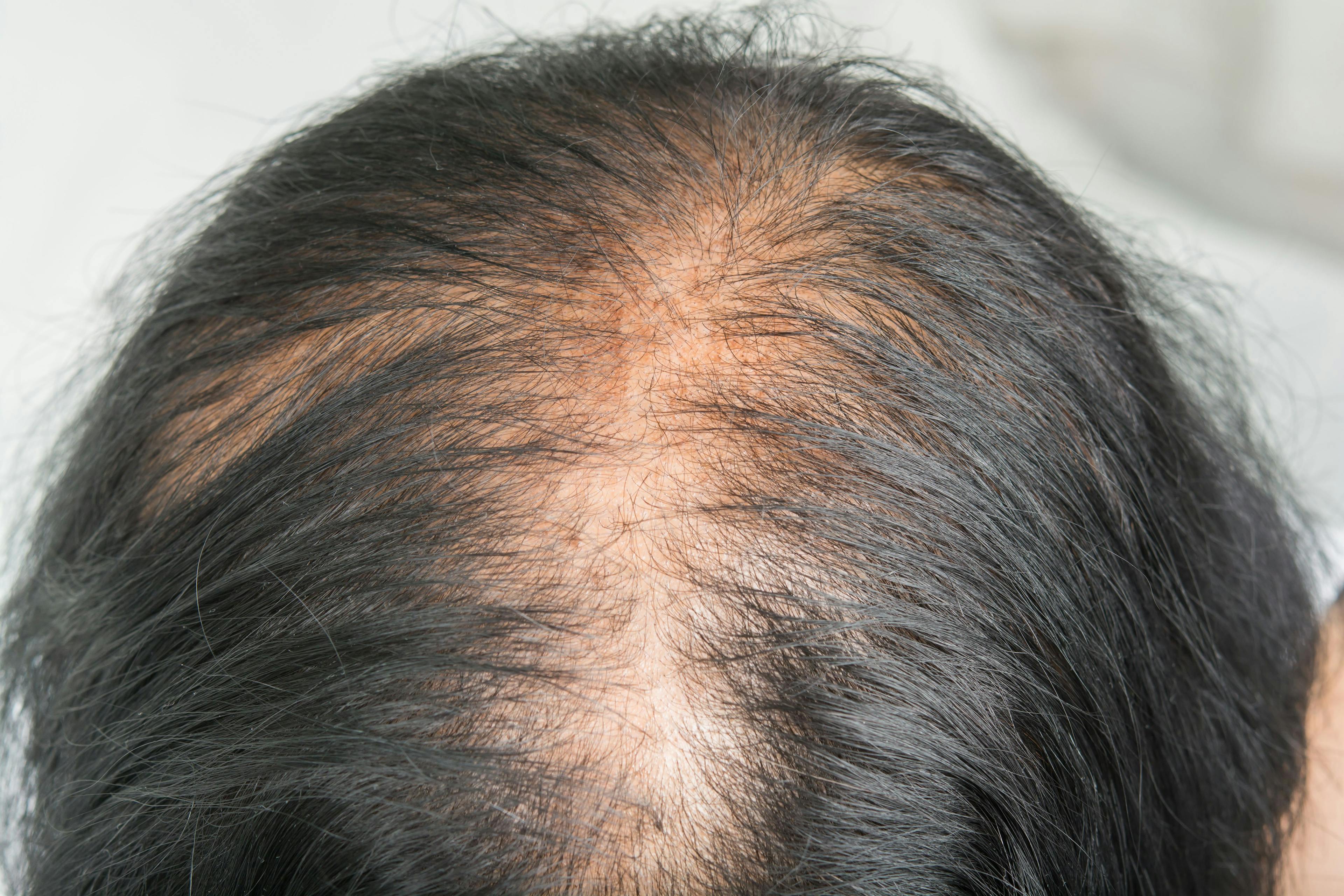 New Safety and Efficacy Data of Ritlecitinib for Alopecia Areata Published in The Lancet  