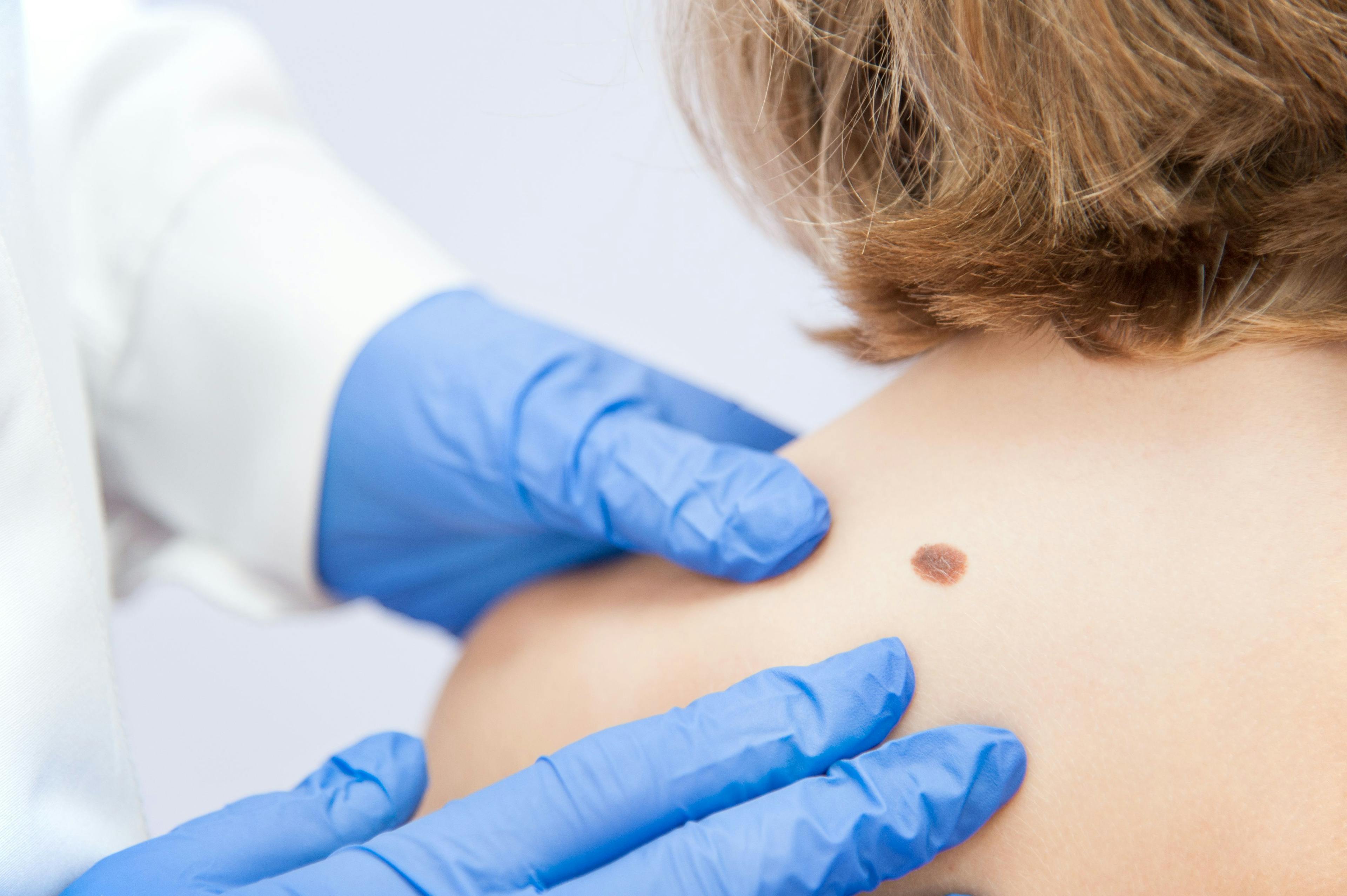 Increasing Rates of Melanoma and What to Look For 