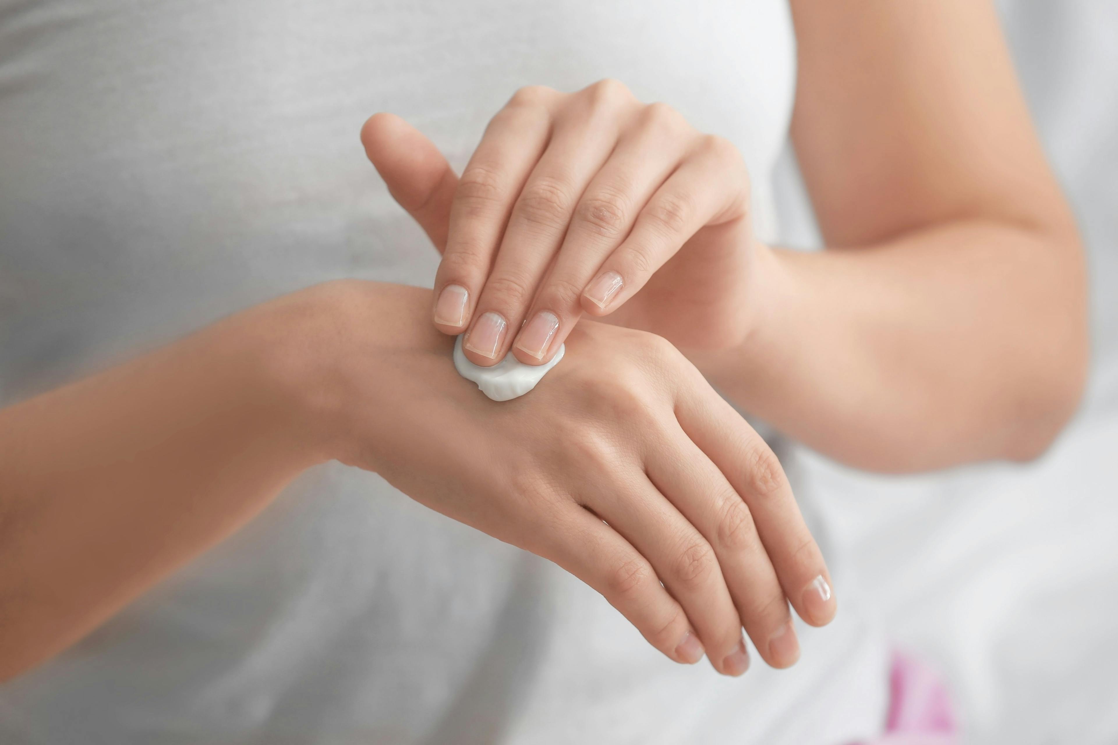LEO Pharma Announces Positive Results for Delgocitinib Cream for Chronic Hand Eczema