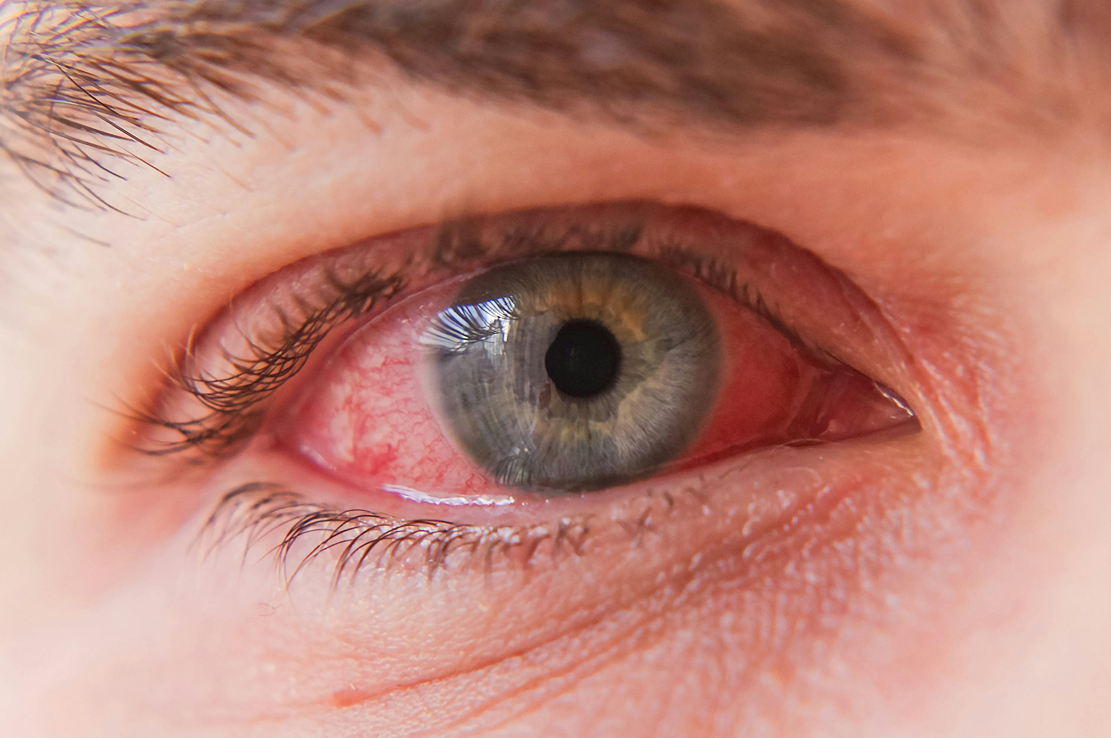 Tralokinumab Linked to Ocular Diseases in Patients with Atopic Dermatitis