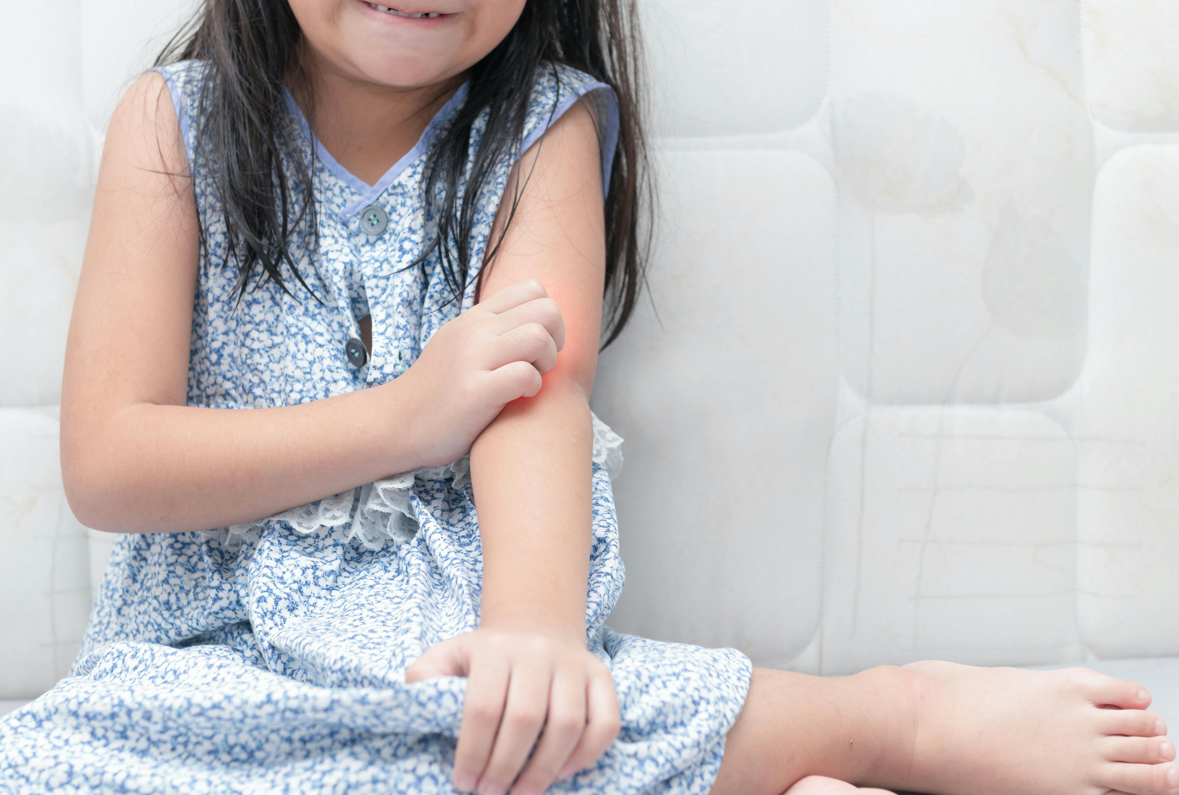 The Burden of Itch for Pediatric Patients and Parents
