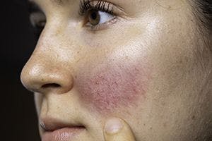 Skin microbiome altered in some rosacea subtypes