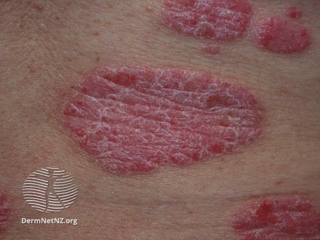 Close-up of well-demarcated plaques with silvery scale in chronic plaque psoriasis

Image courtesy of DermNet