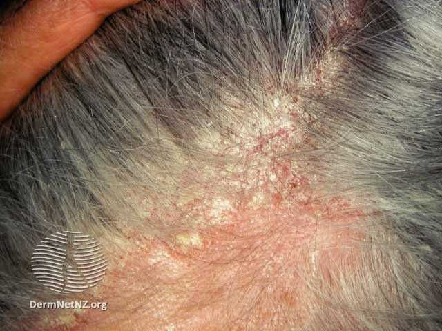 Confluent erythema and scale due to scalp seborrhoeic dermatitis

Images courtesy of DermNet