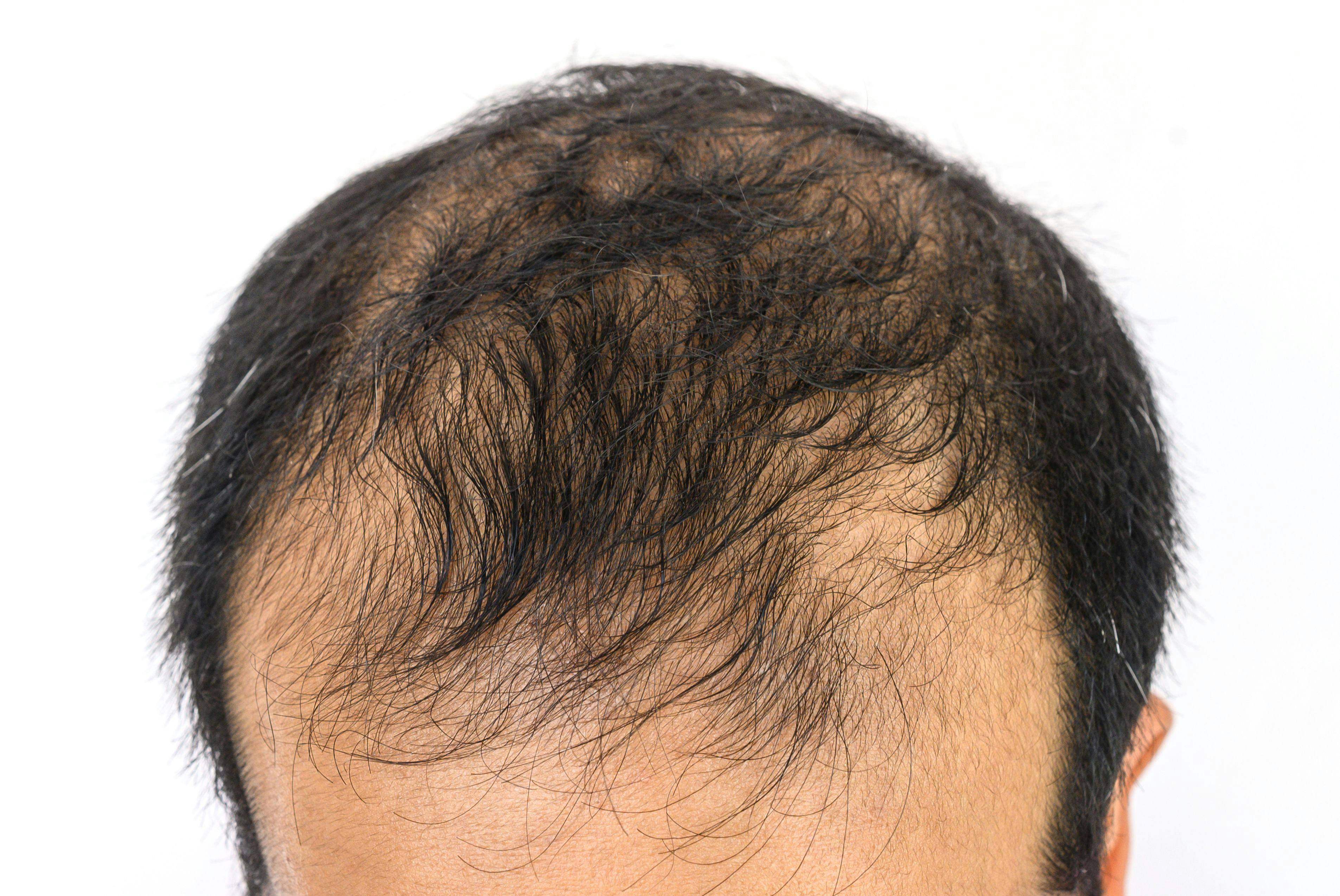 Dermoscopy Assessment Showed Efficacy of Botulinum Toxin A in Egyptian Patients With Androgenetic Alopecia
