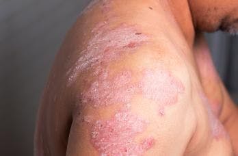 Psoriasis on the shoulder