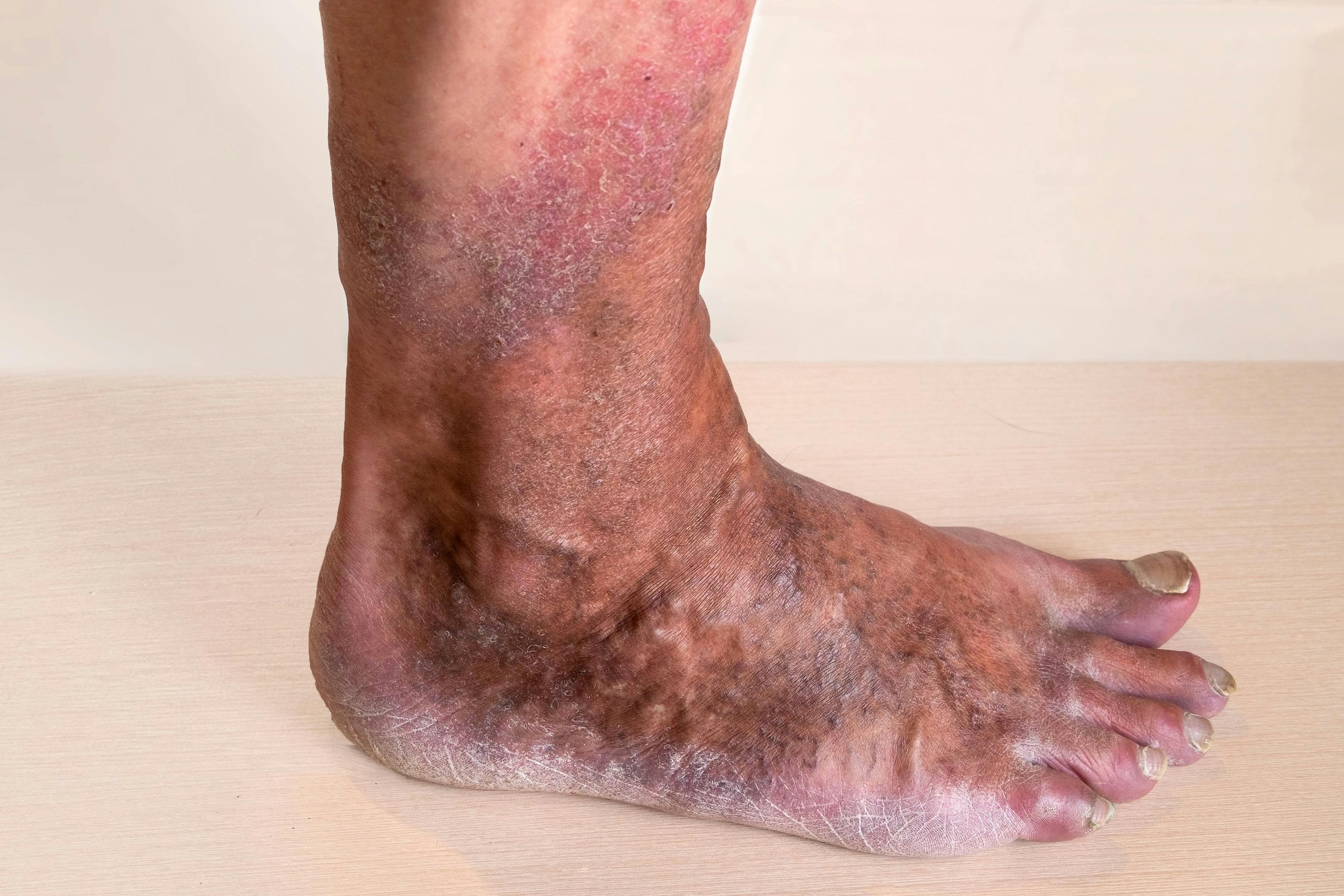 Remote Assessments Show Crisaborole Ointment Eases Stasis Dermatitis 