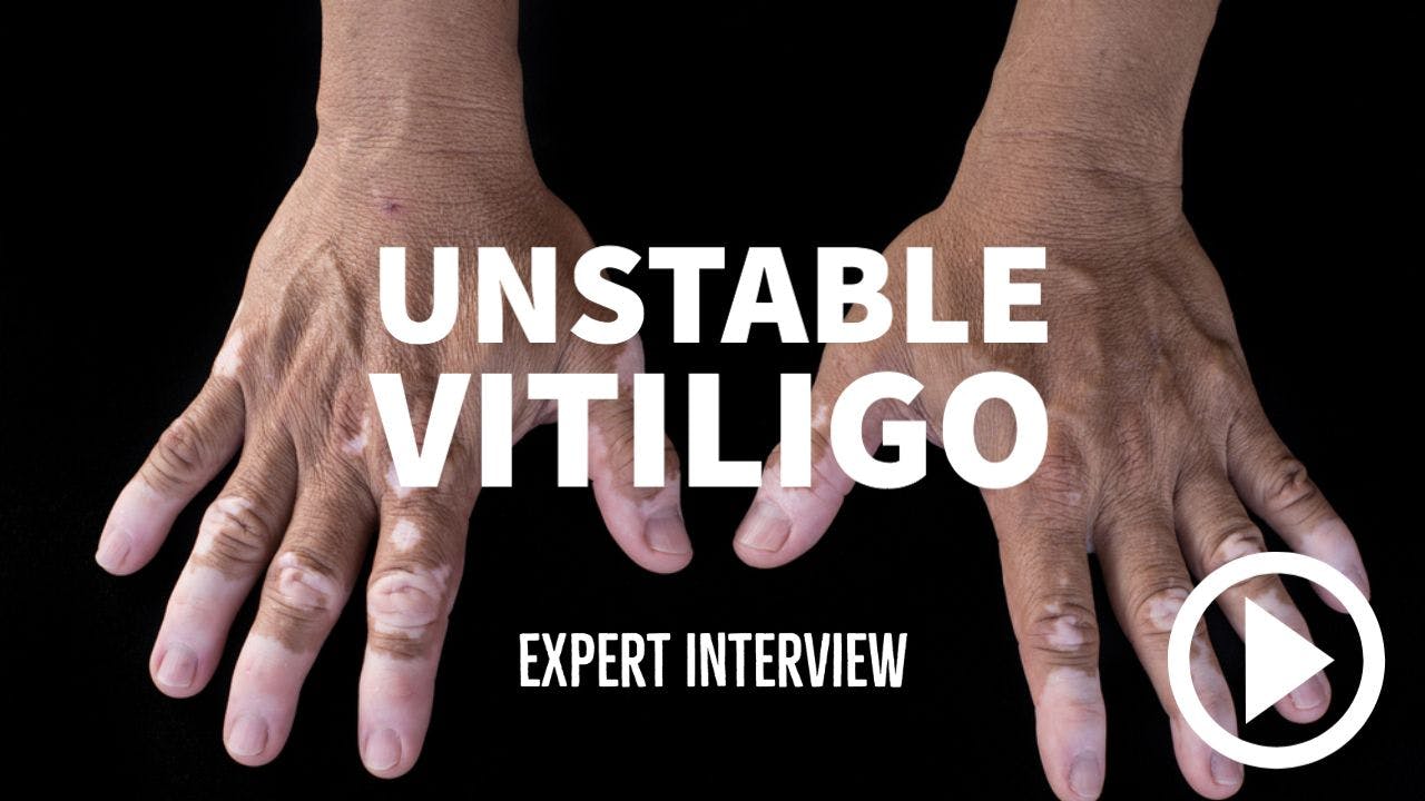 Hands with vitiligo. Writing: Unstable Vitiligo - Expert Interview