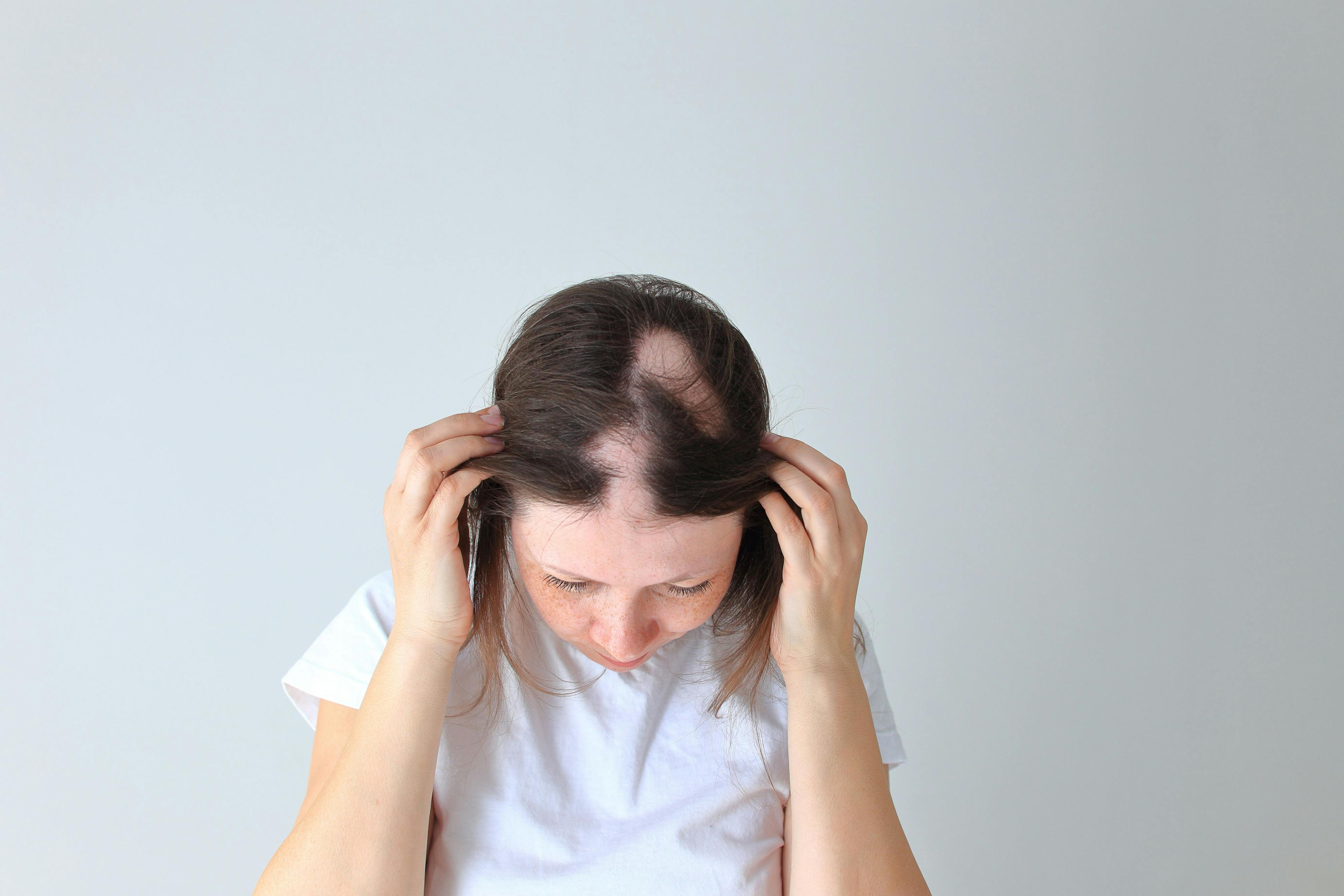 Anxiety and Depression Prevalent in Patients With Alopecia