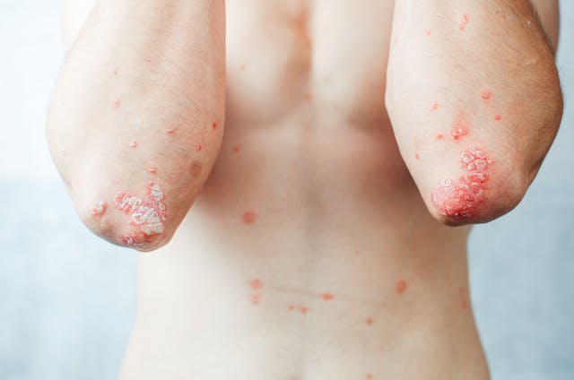 Advancements in Psoriasis Treatments 