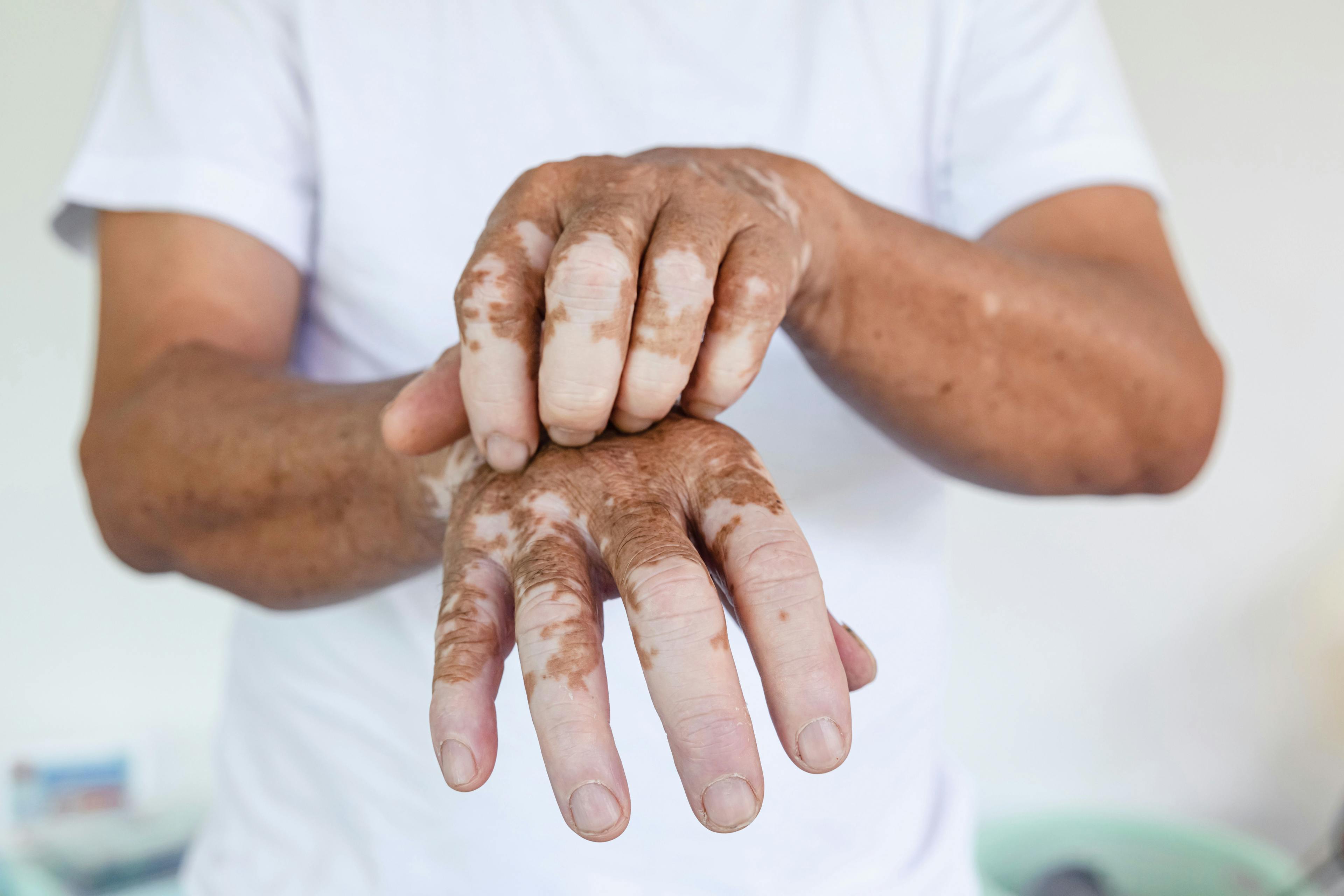 Man with vitiligo on the hands has one hand over the other, scratching it.