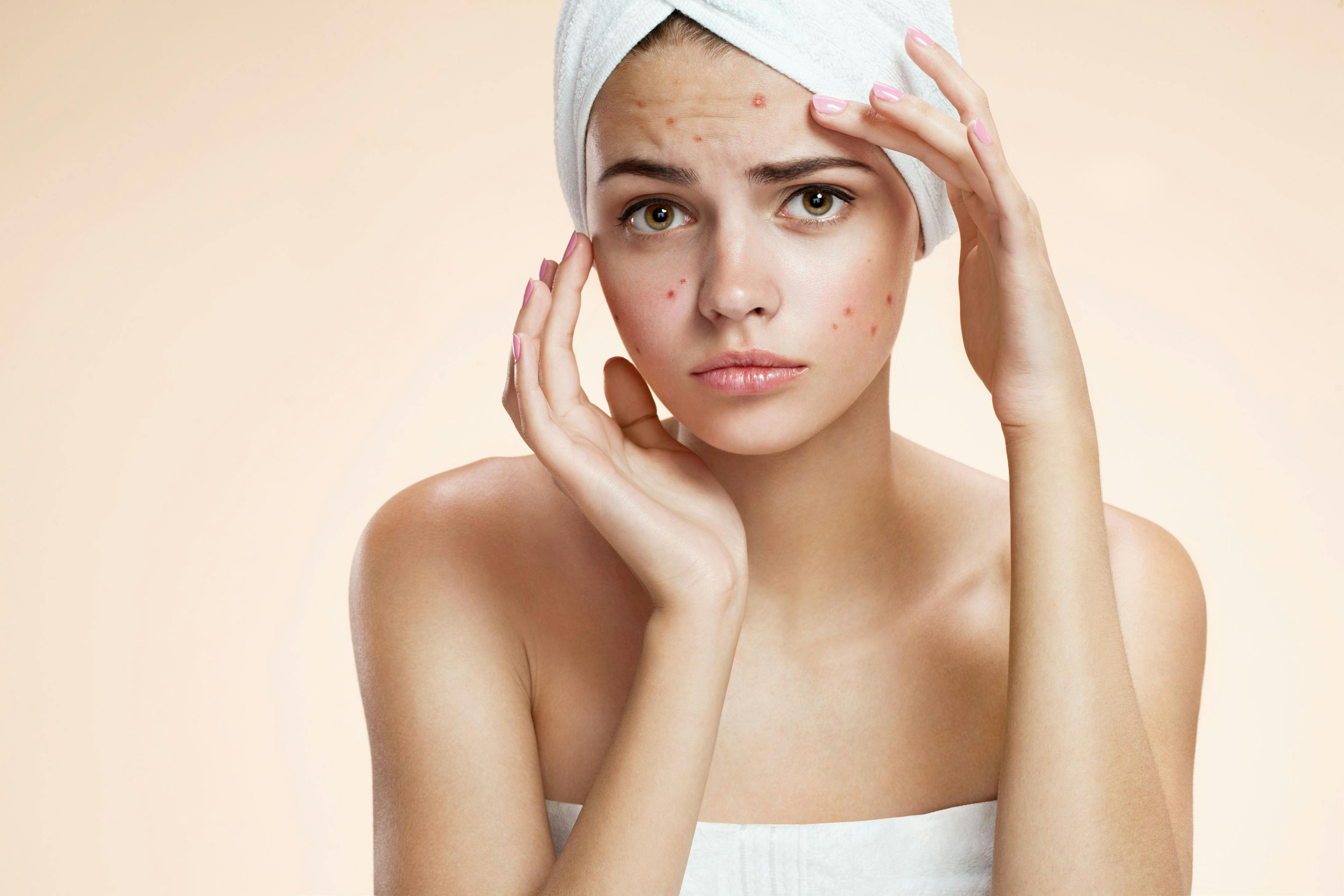 Treatment improves QOL for patients with acne 