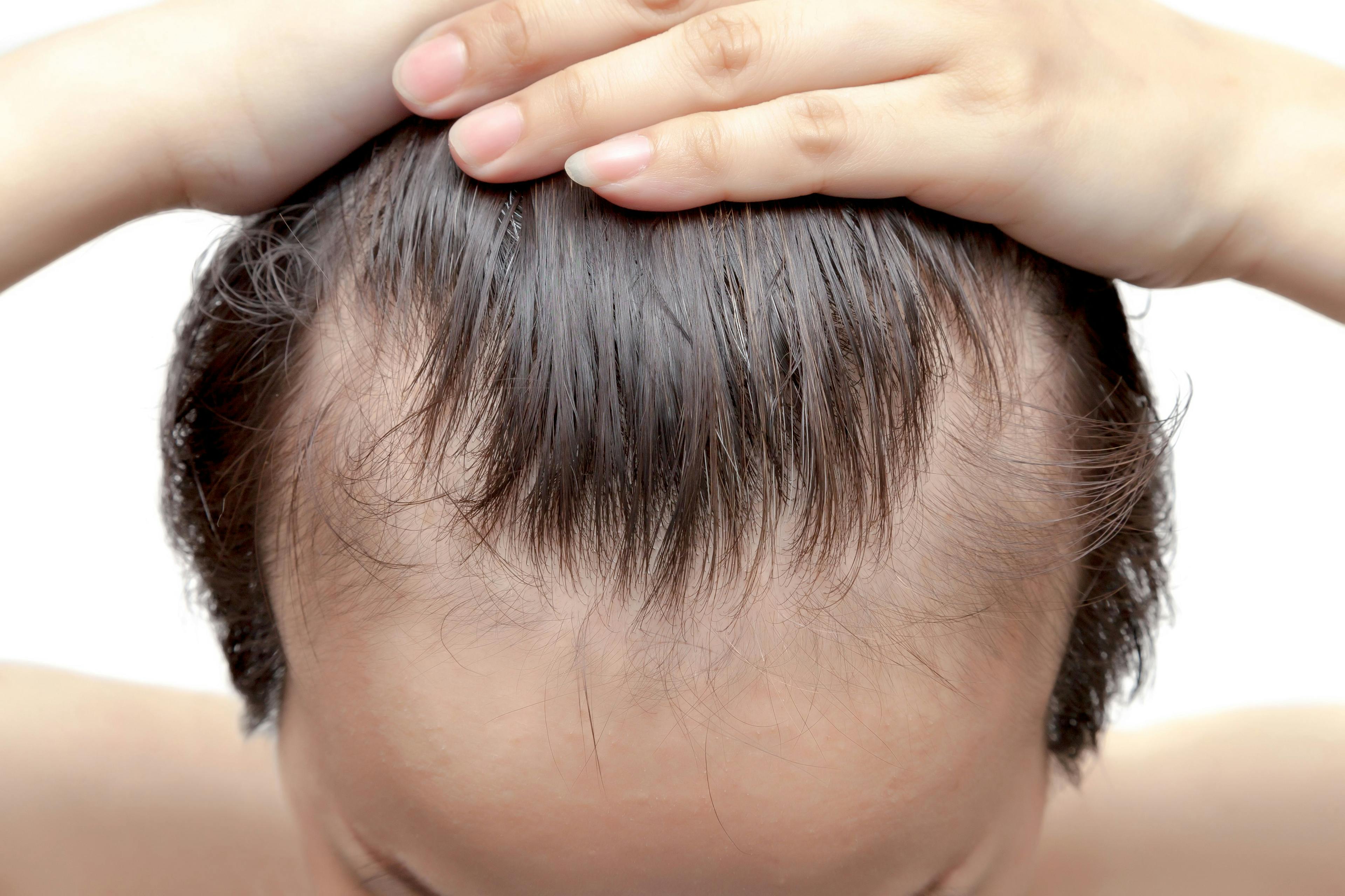 Amino Acid- Containing Supplement May Improve Clinical Efficacy of Hair Loss Treatments