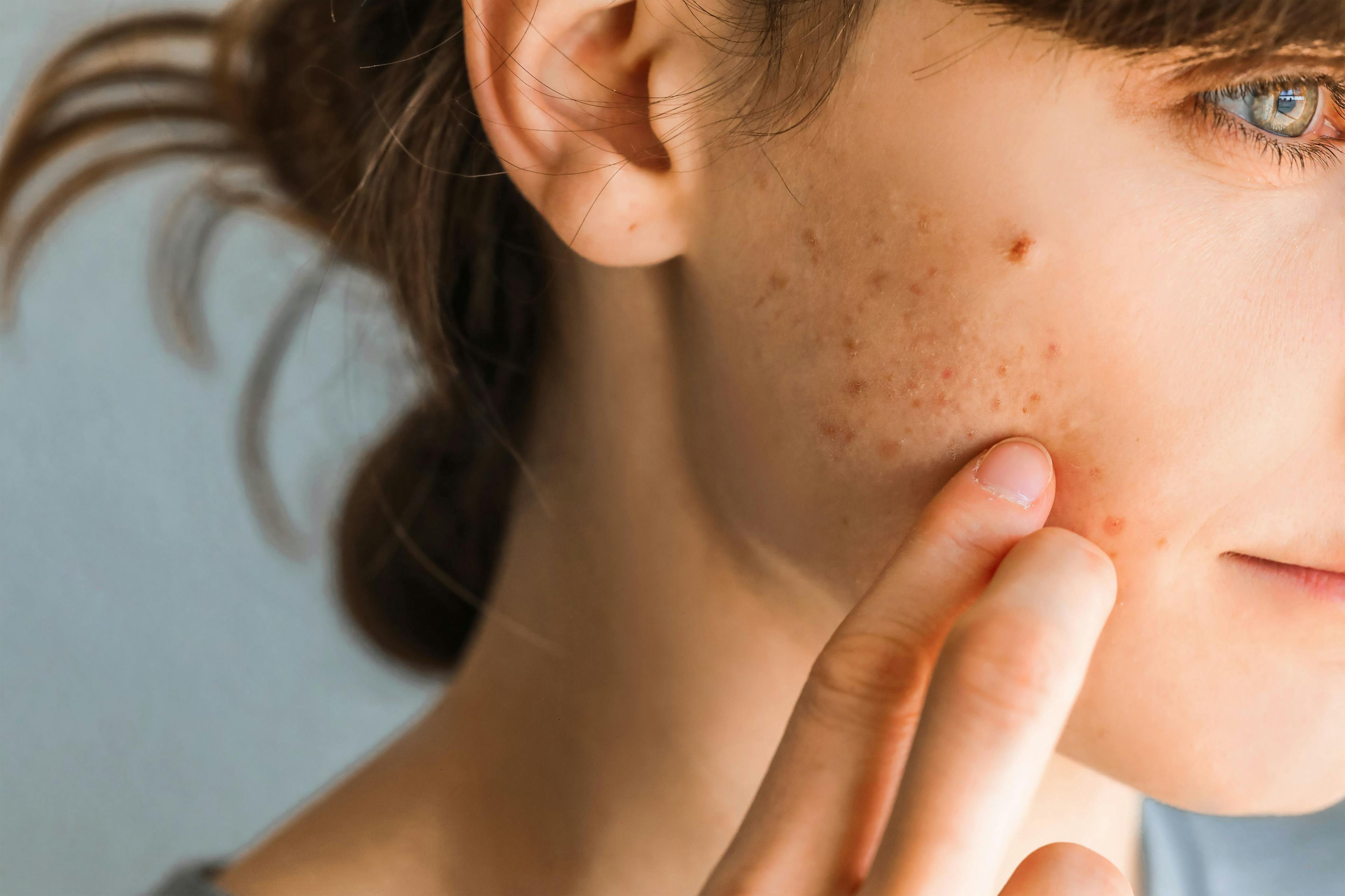 Symptoms and Impact of Acne Vulgaris on Pediatric Patients 