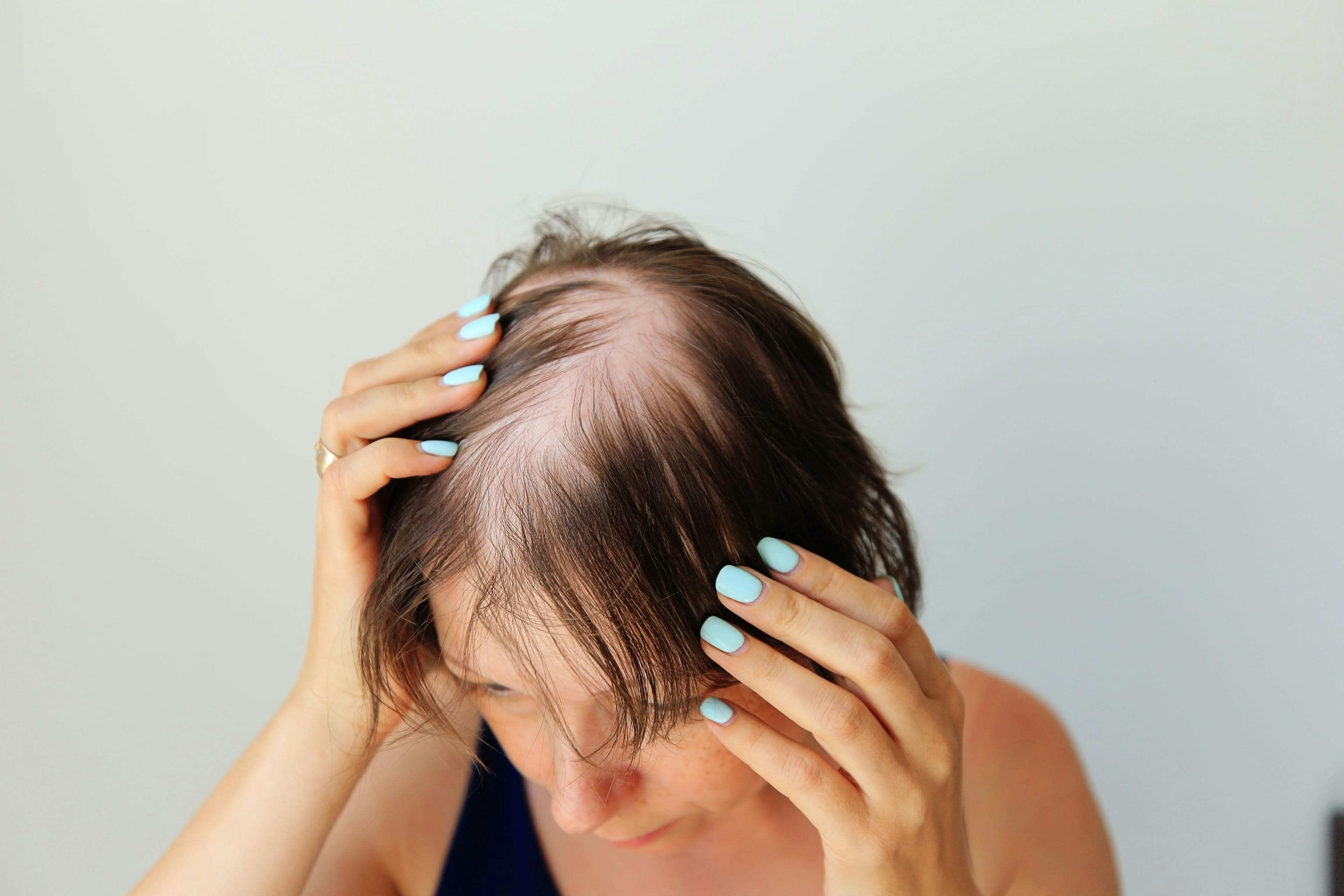 Alopecia Areata: A Comprehensive Overview and Breakthrough Therapies 