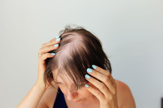 Alopecia Areata Linked to Hearing Loss, Study Finds