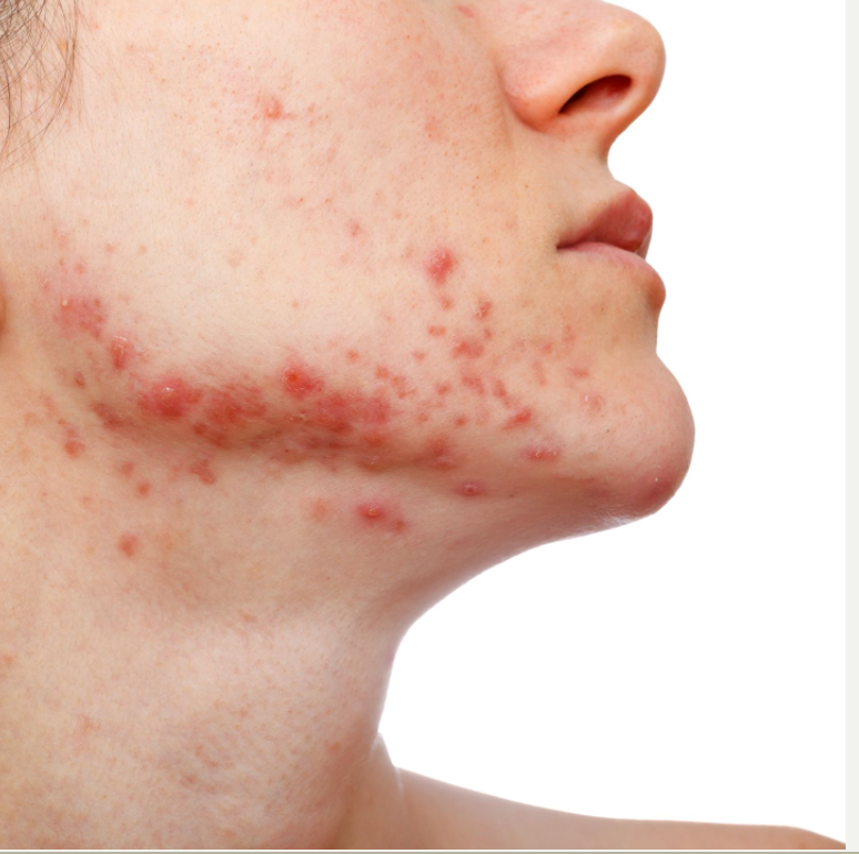 Favorable Safety, Efficacy Data on Newer Acne Vulgaris Treatment 
