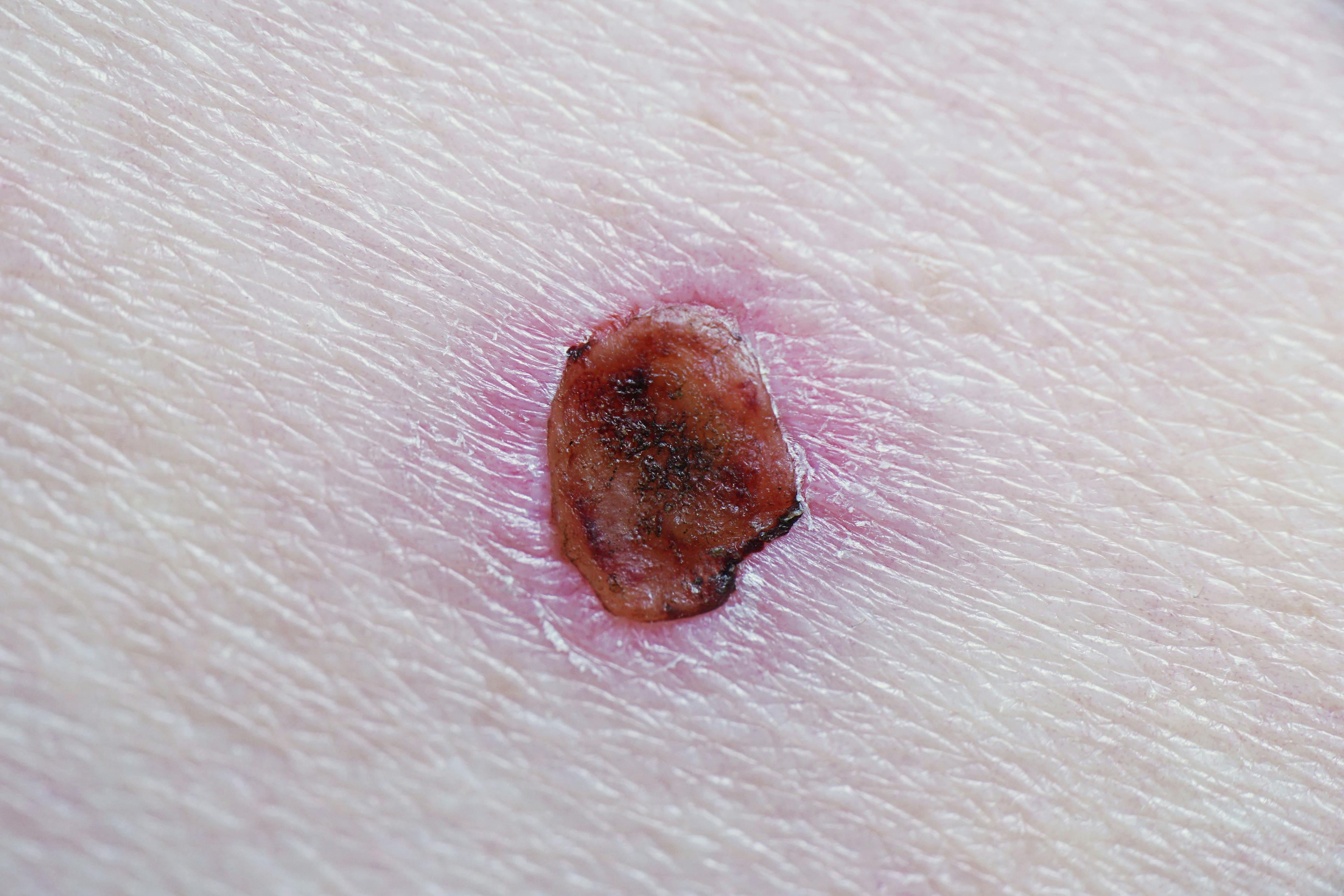 Review Explores Advanced Basal Cell Carcinoma Mechanisms and Targeted Therapies