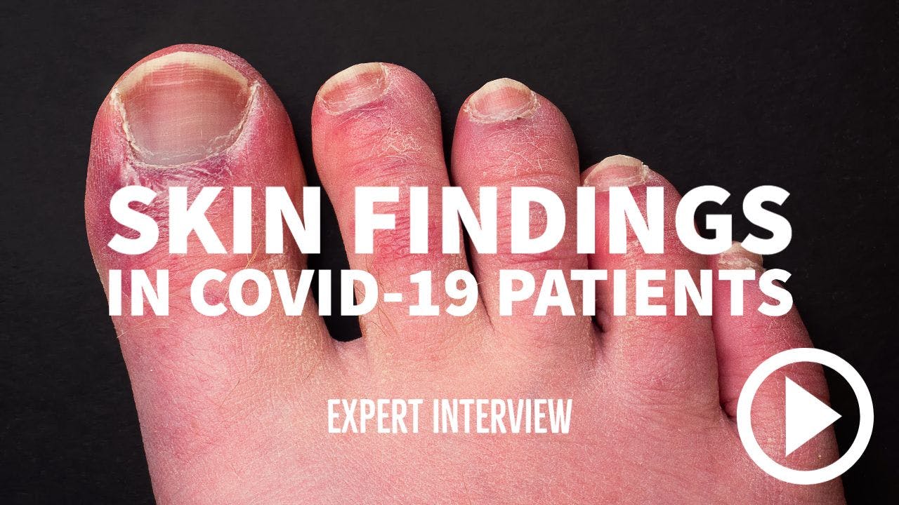Image of COVID toes with writing "Skin Findings in COVID-19 patients" 