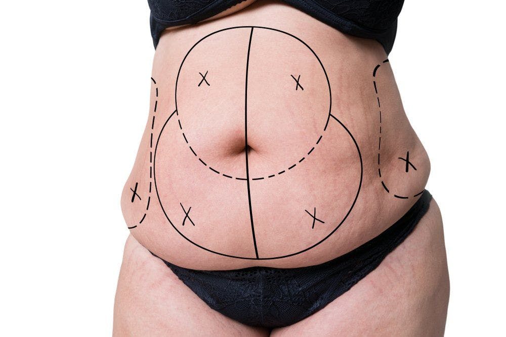 A paradigm shift for treating unwanted fat