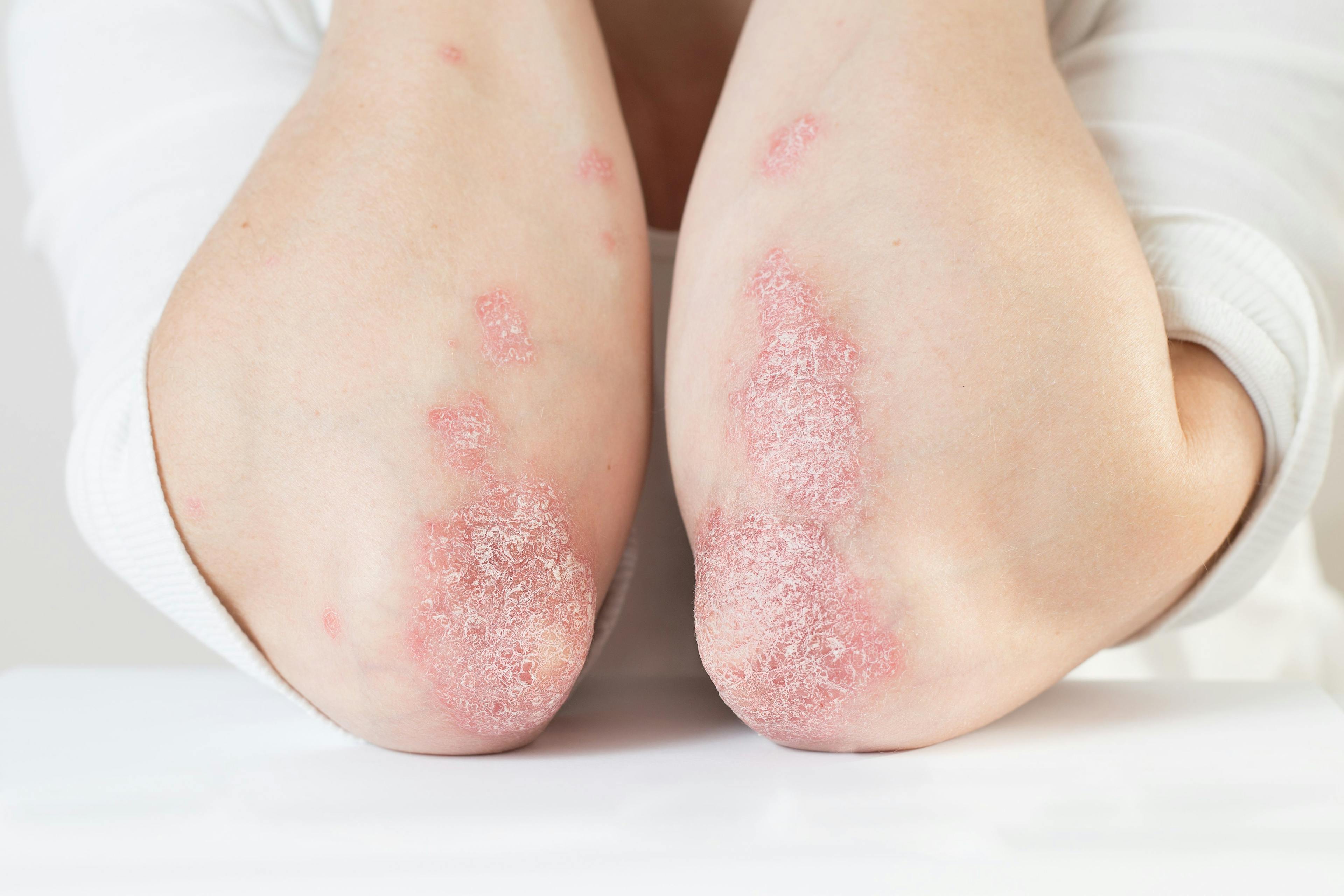 Infection Risk Lower With IL-23i and IL-17i Than With TNFi in Psoriasis
