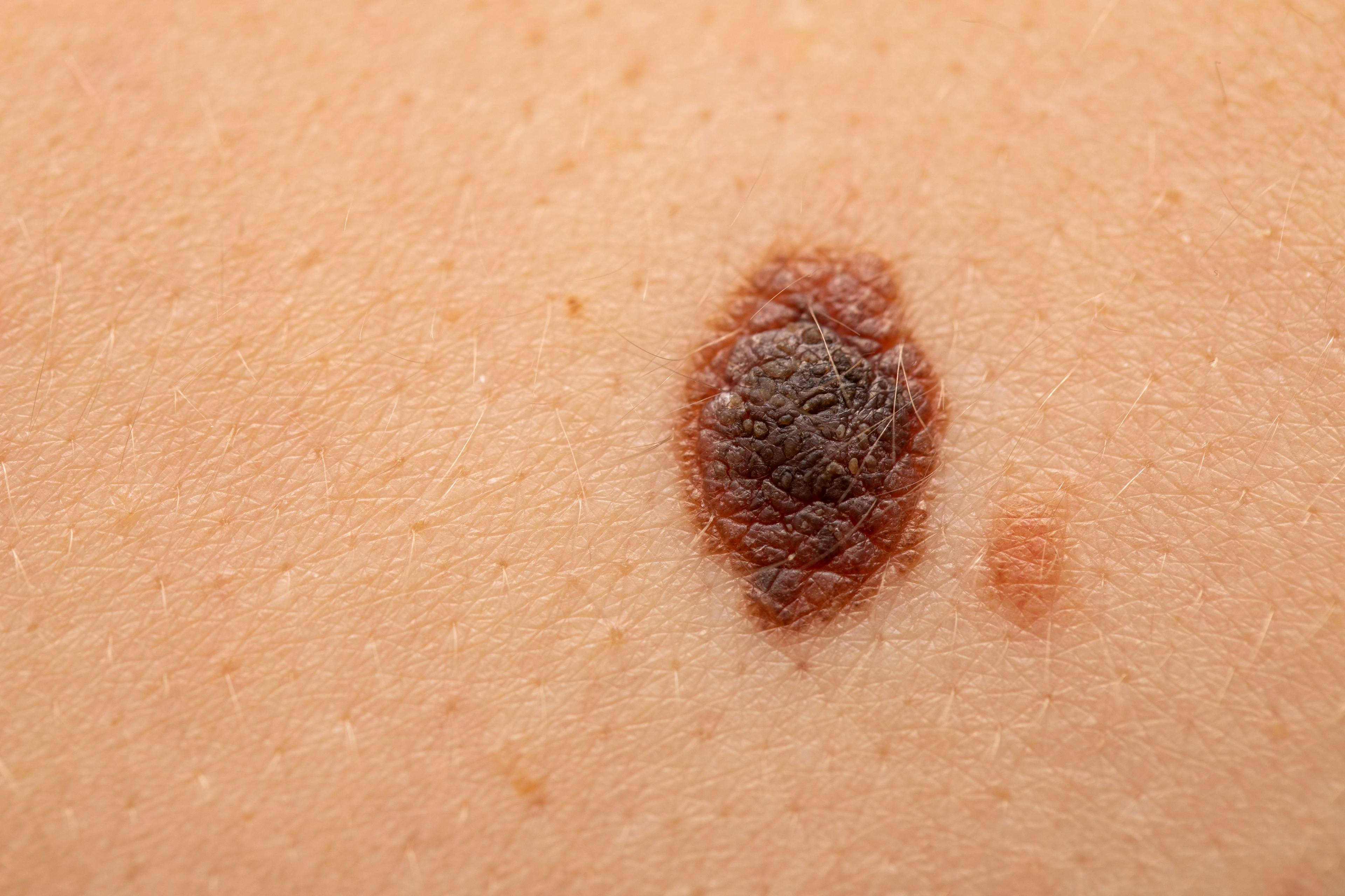 31-Gene Expression Profile Test Accurately Classified Risk of Death From Melanoma