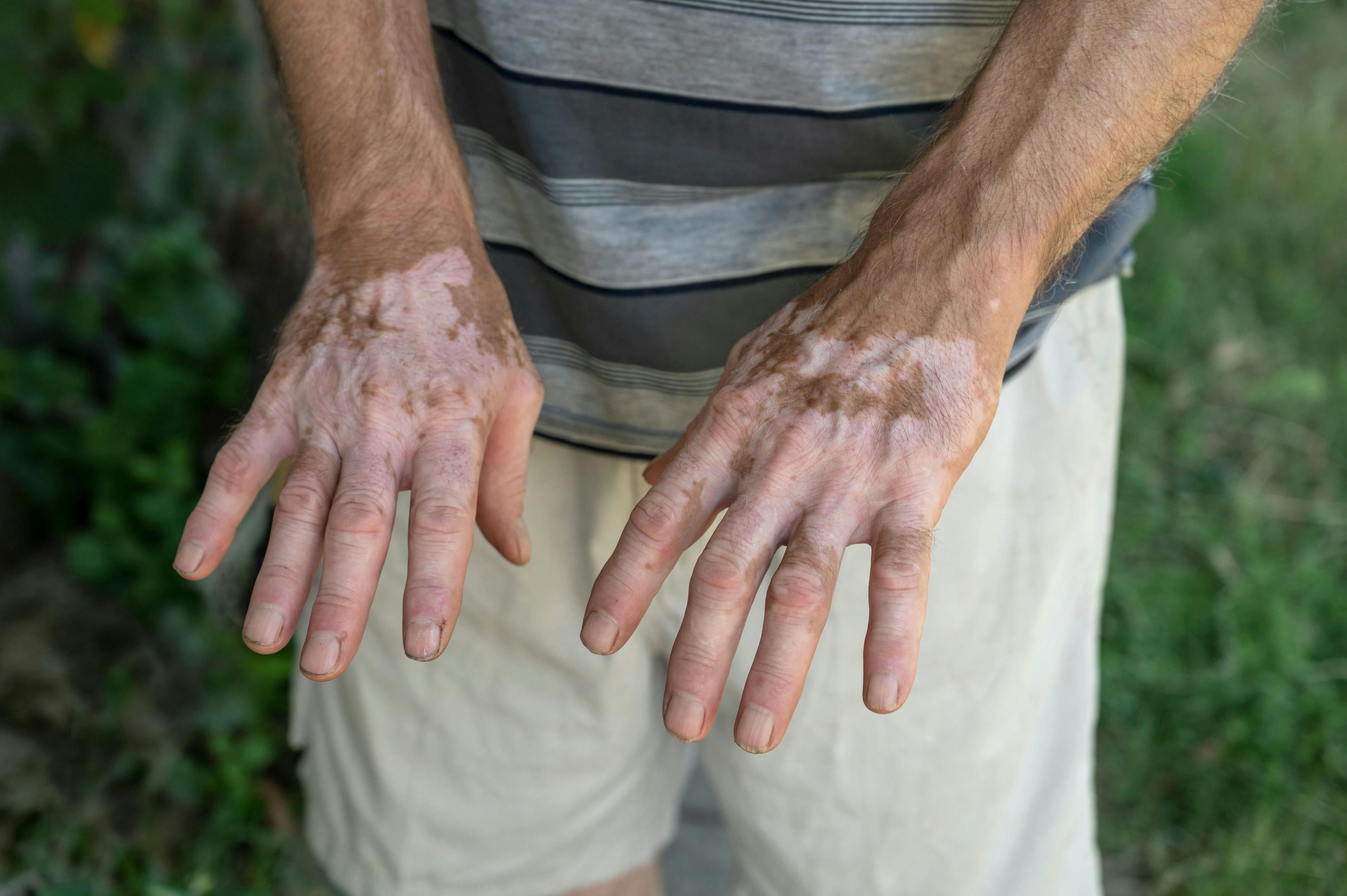 Research Examines Link Between Vitiligo and Systemic Sclerosis