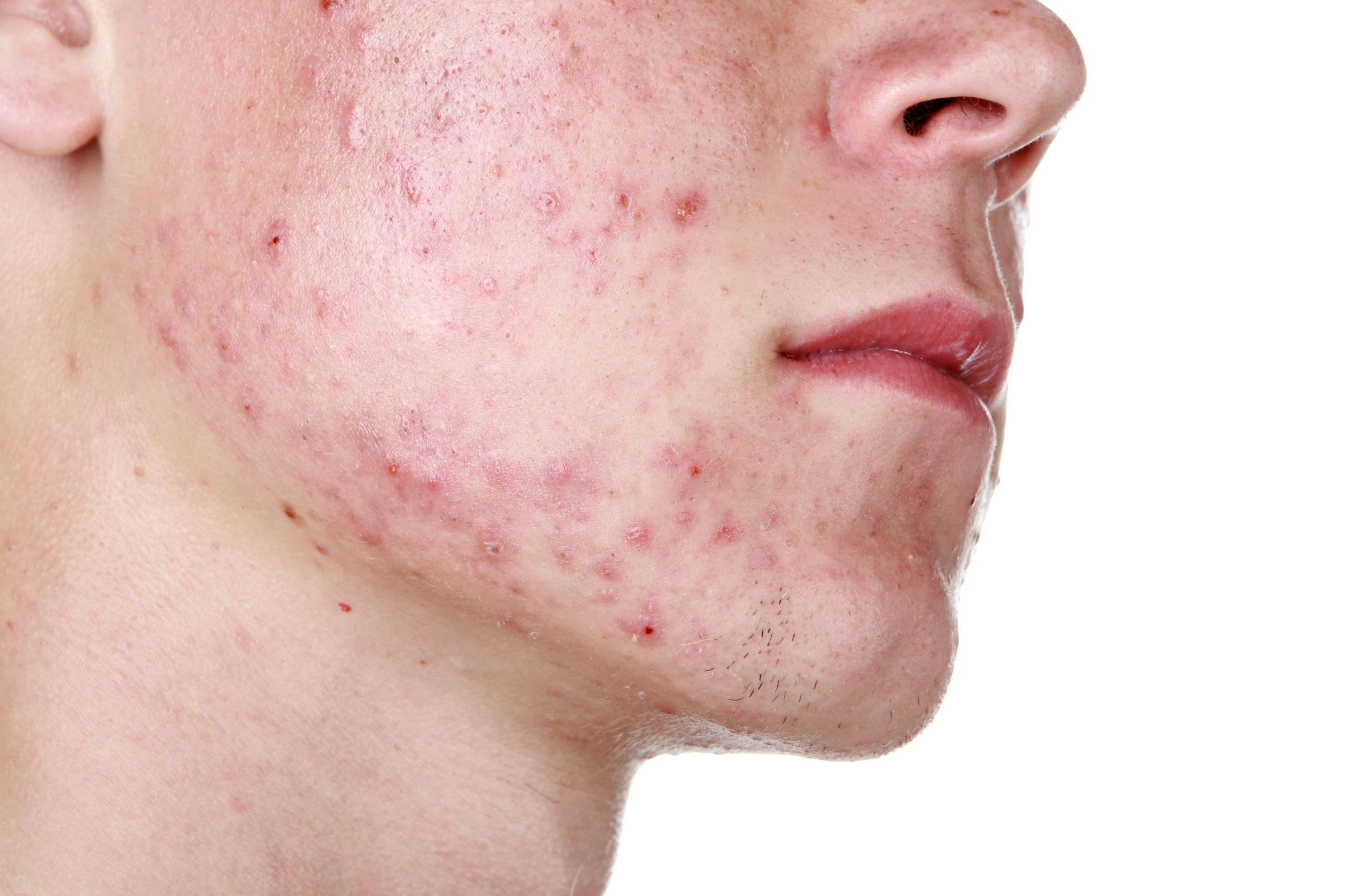 FDA Clears Accure Laser System for Acne Treatment  