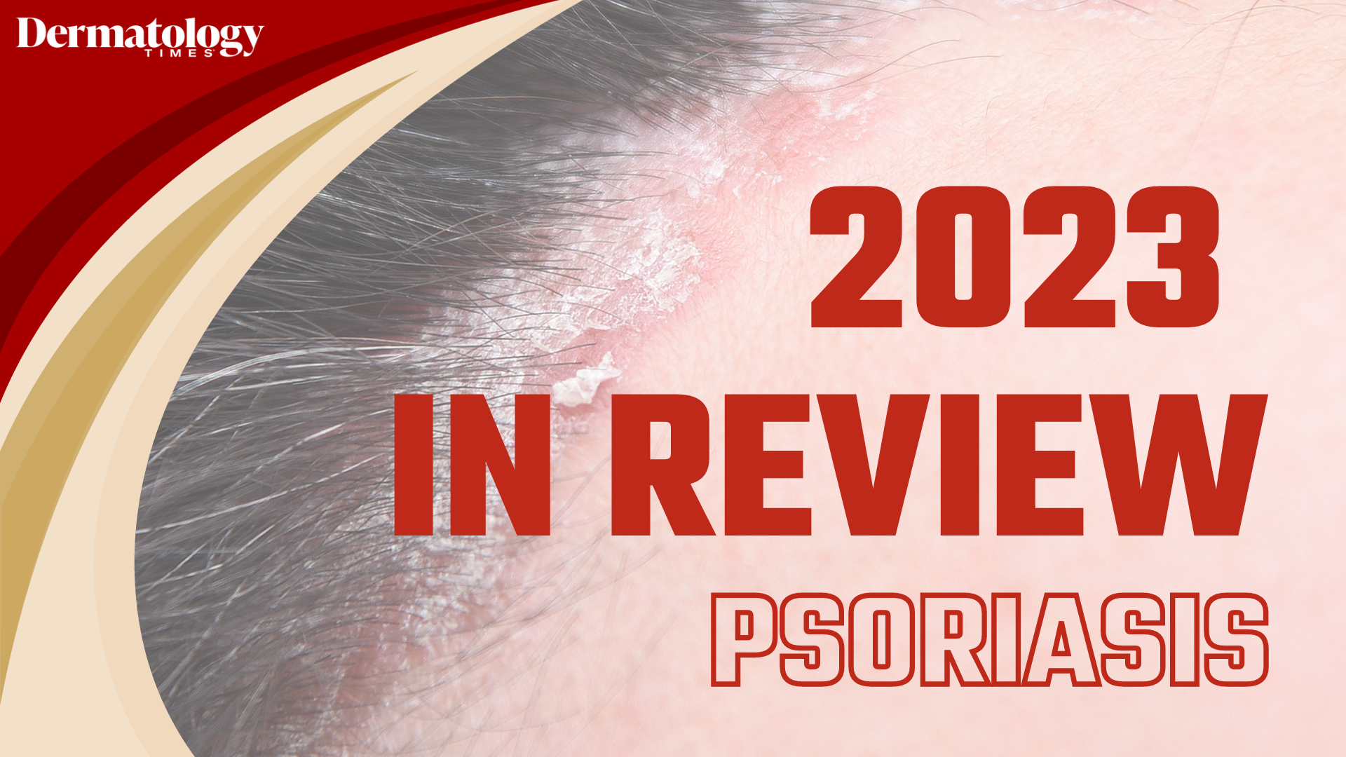 Dermatology Times 2023 In Review: Psoriasis