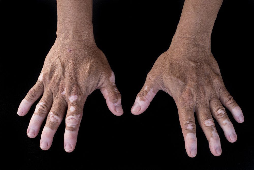 vitiligo on hand