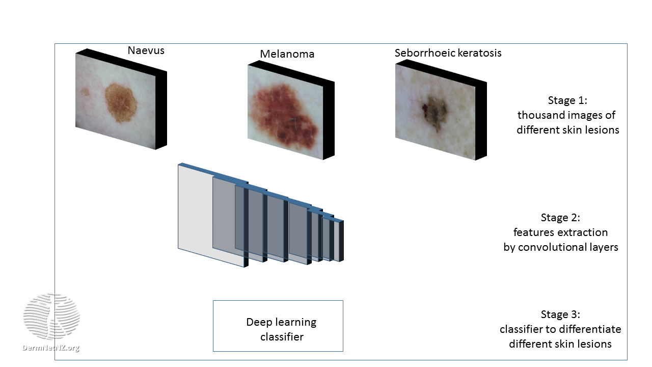 Overview of training of different types of skin lesions with the help of deep learning

Image courtesy of DermNet